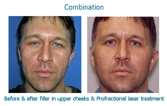 combo filler PF RT (2018_06_07 22_47_36 UTC).jpg