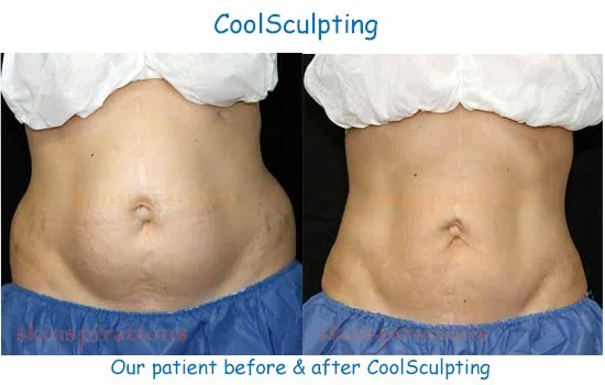  Results of Coolsculpting treatments to reduce belly fat. 