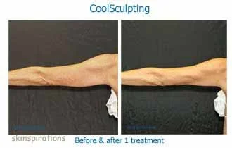 Before and after Coolsculpting fat removal at Skinspirations