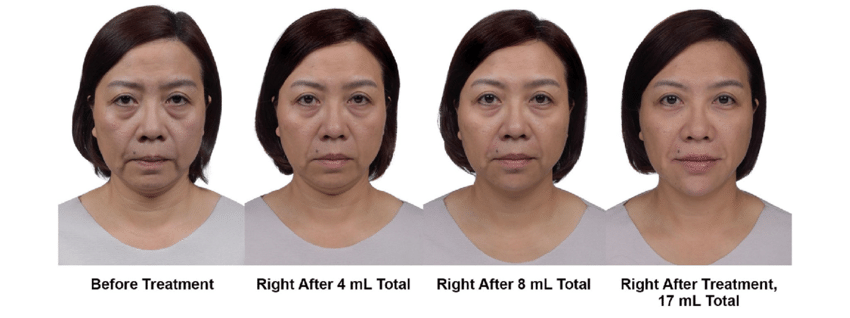 Before and after MD Codes facial filler treatments