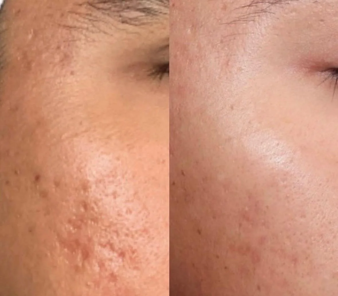 acne scarring treatments in oxford al
