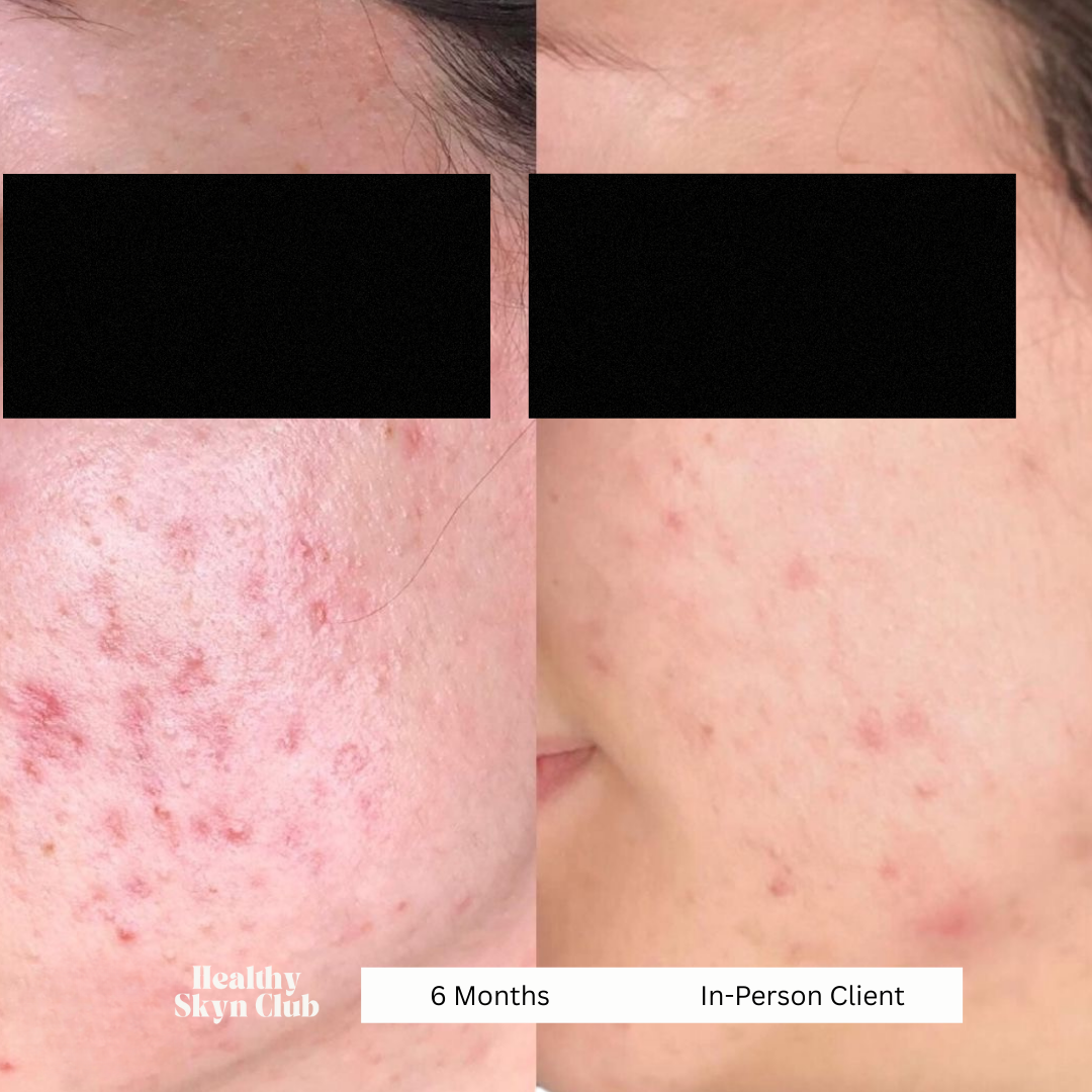 how to treat acne scarring - healthy skyn club oxford, al