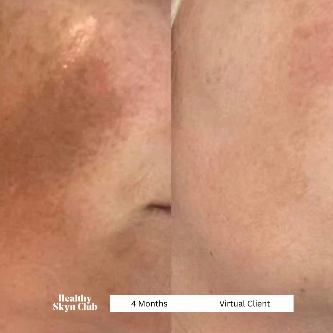 Virtual skincare esthetician melasma before and after