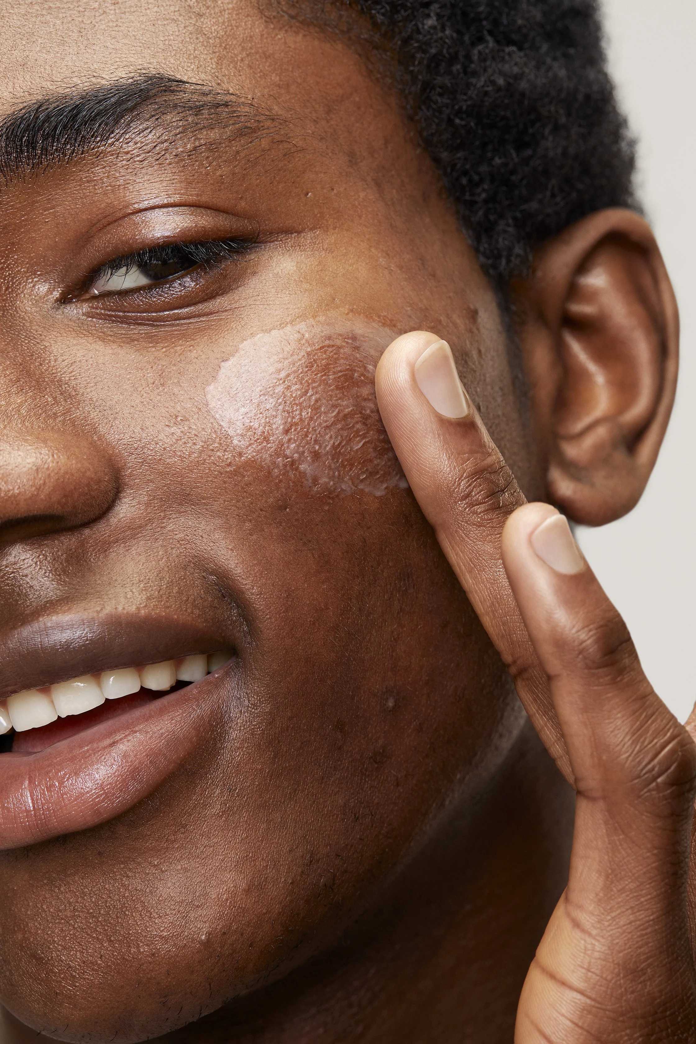 ACNE_LOTION-Model_02.jpg