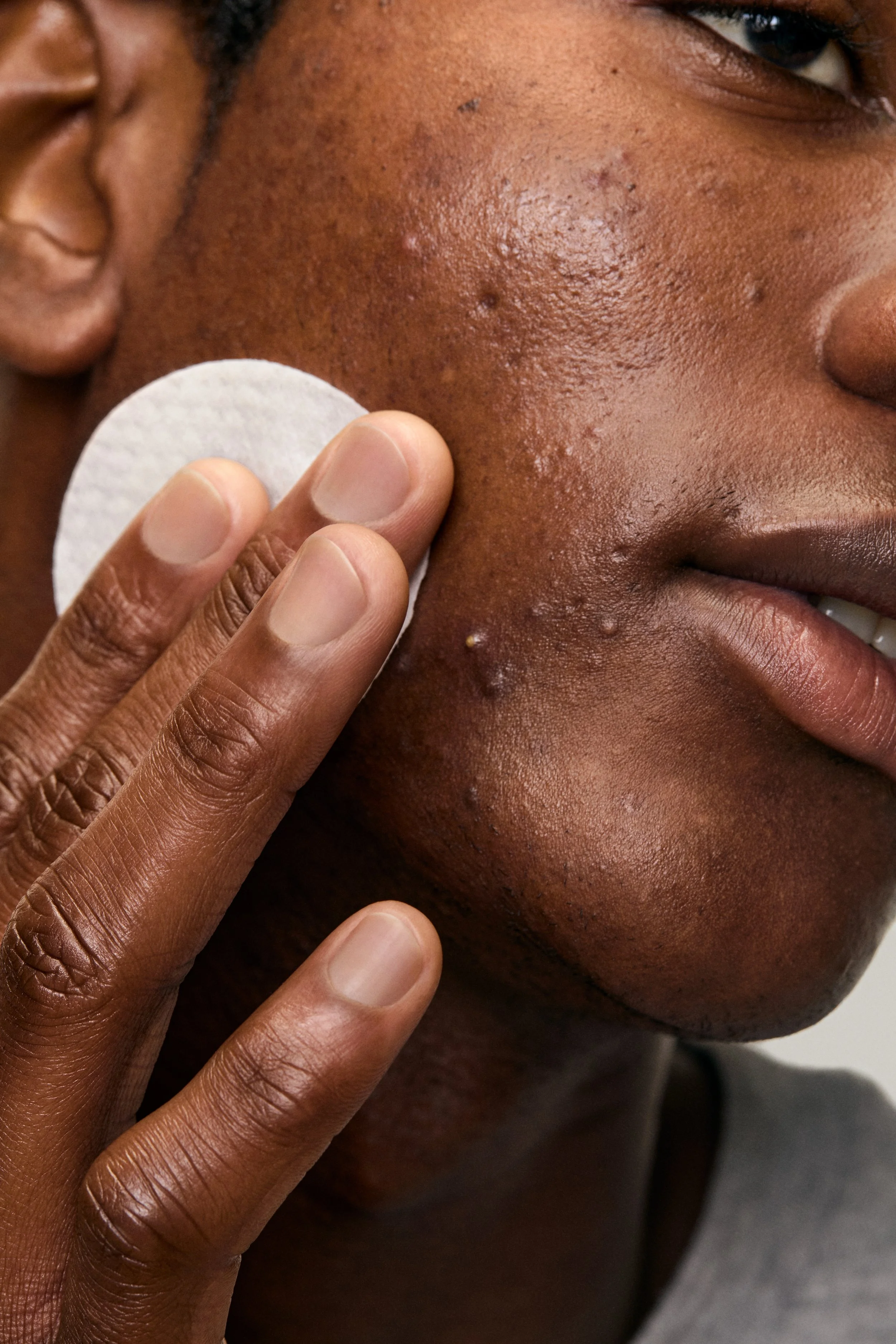ACNE _PADS-Model_04.jpg