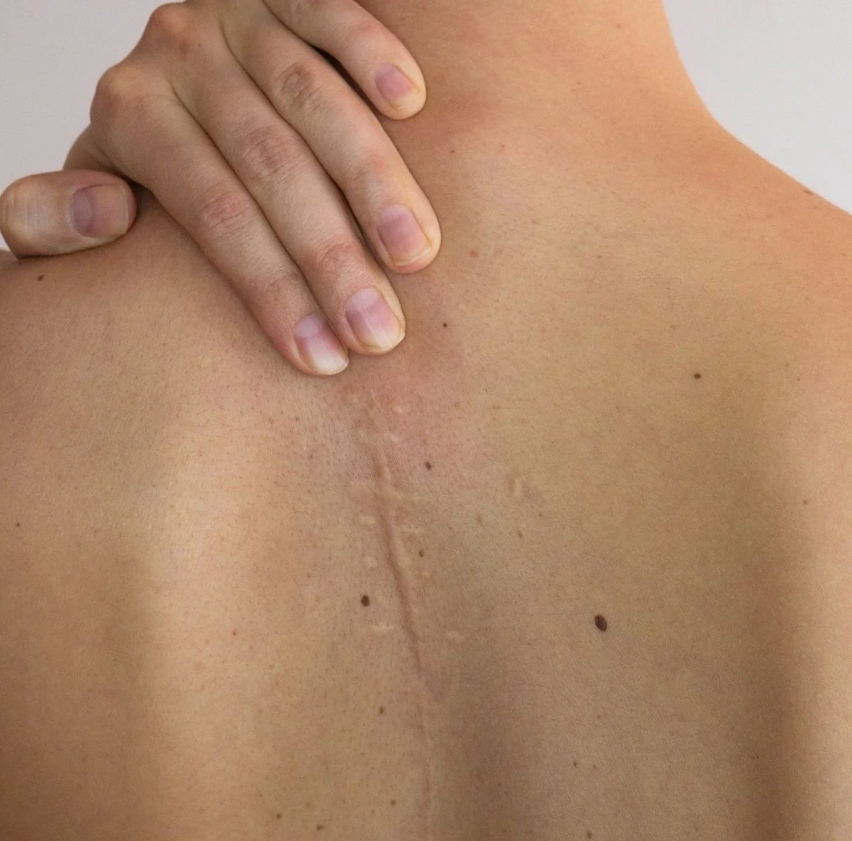 A person's shoulder and back with a U-shaped scar and multiple small moles, and their hand resting on their shoulder.