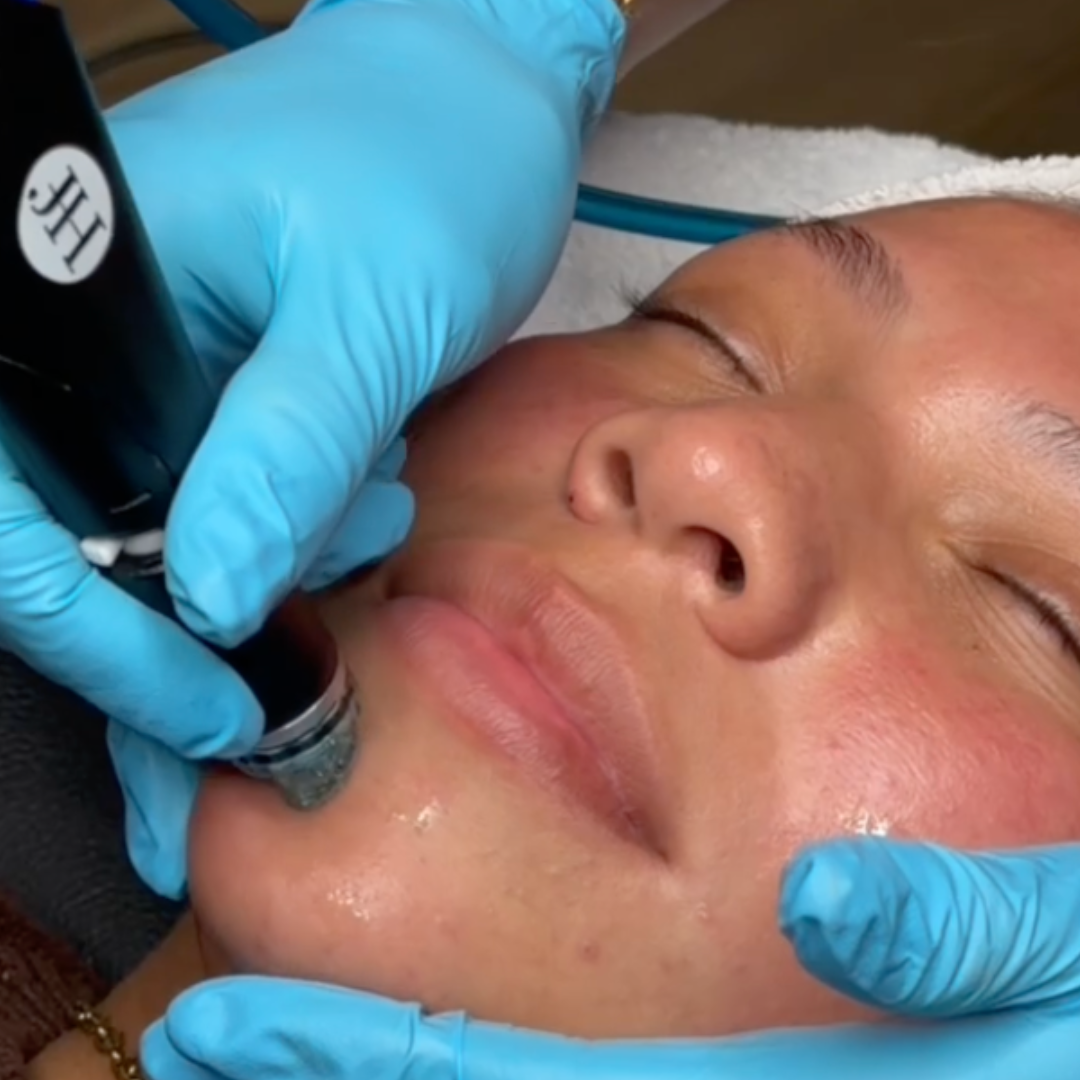 HydraFacial MD treatment in Lakeland, Florida at SkinRX.FL
