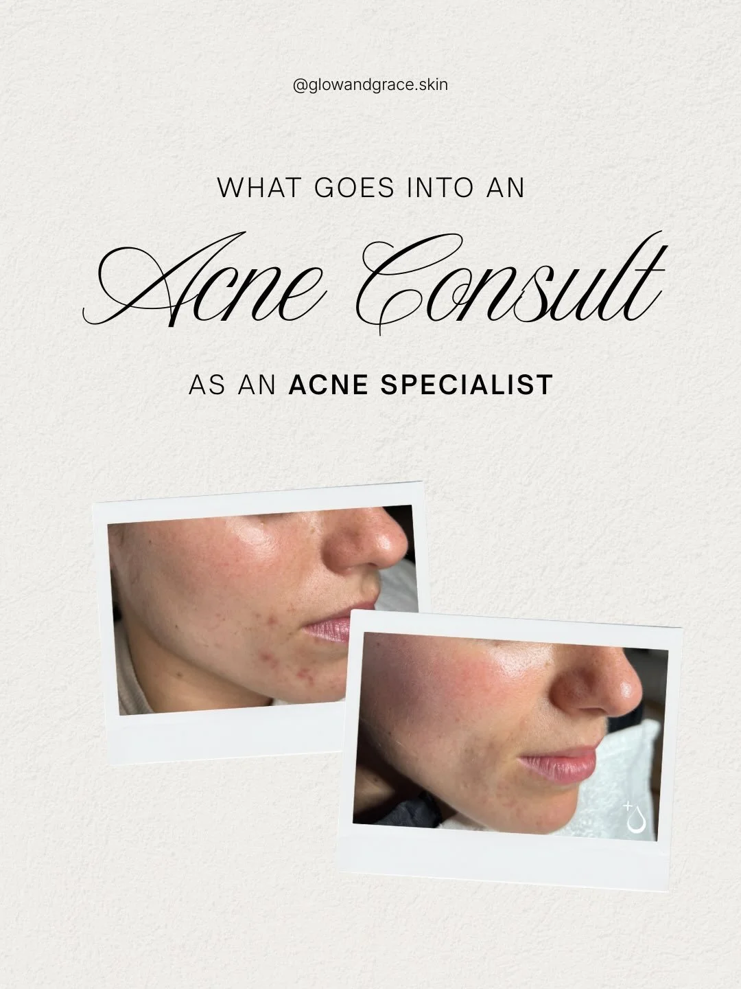 What do I look for during an acne consultation? Everything. 🤓

Acne isn&rsquo;t just surface level, and you deserve more than a &lsquo;one-size-fits-all&rsquo; cream. I look at your skin story&mdash;from your cycle and stress levels to your skin bar