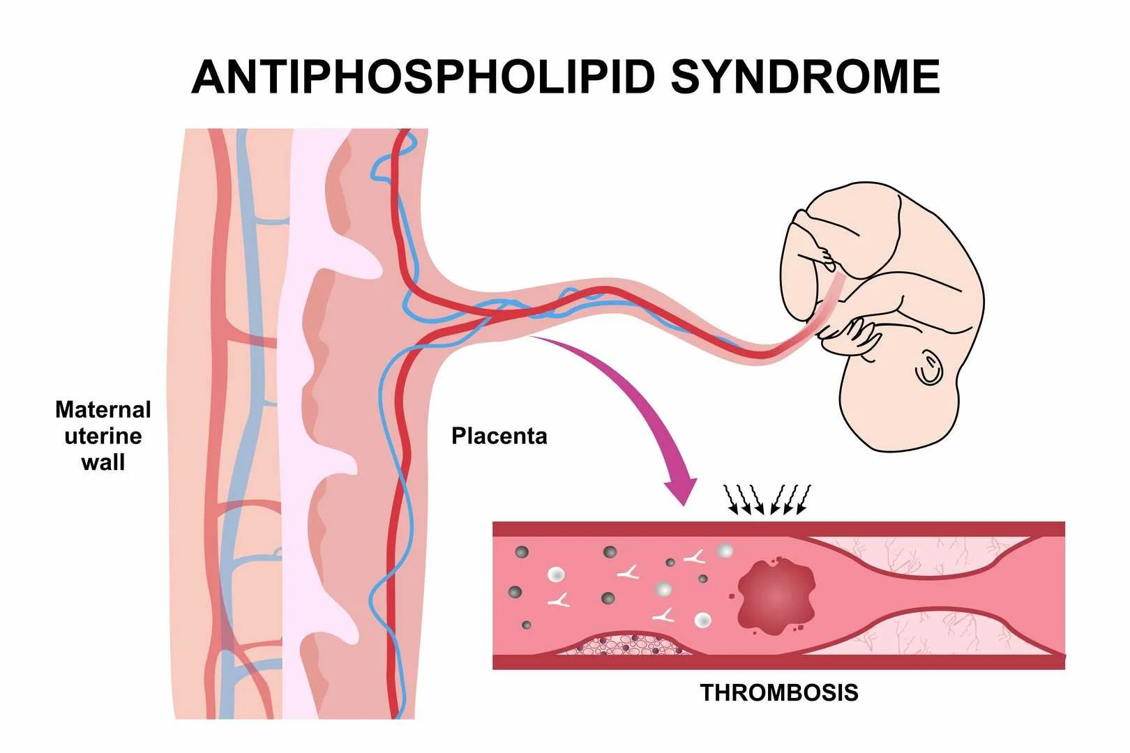 Antiphospholipid Syndrome (APS)