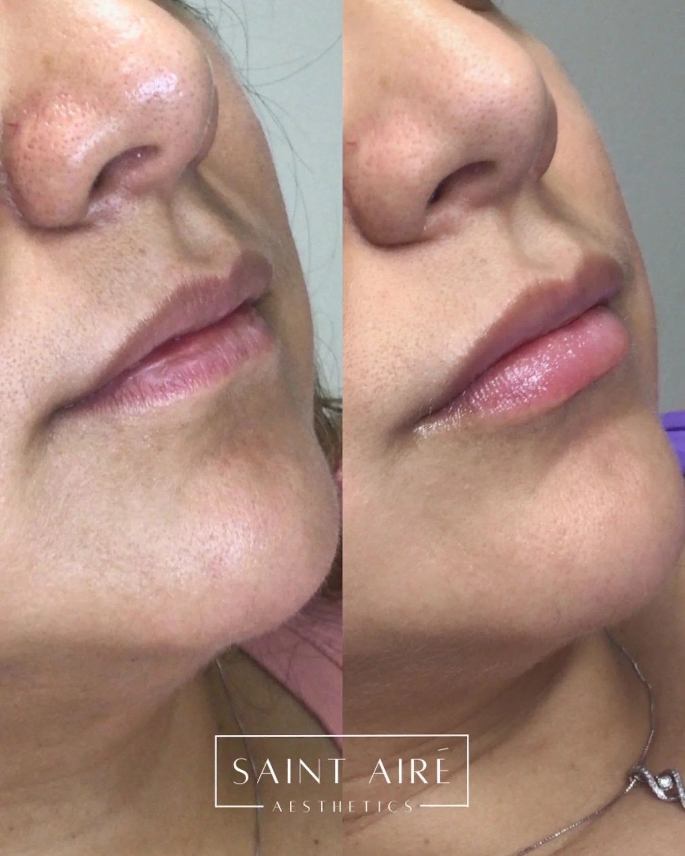 Healed result of a 1/2 syringe of lip filler for this first time patient 💋 our goal was proportion and hydration!

#lipfiller #rha #revance #naturalresults