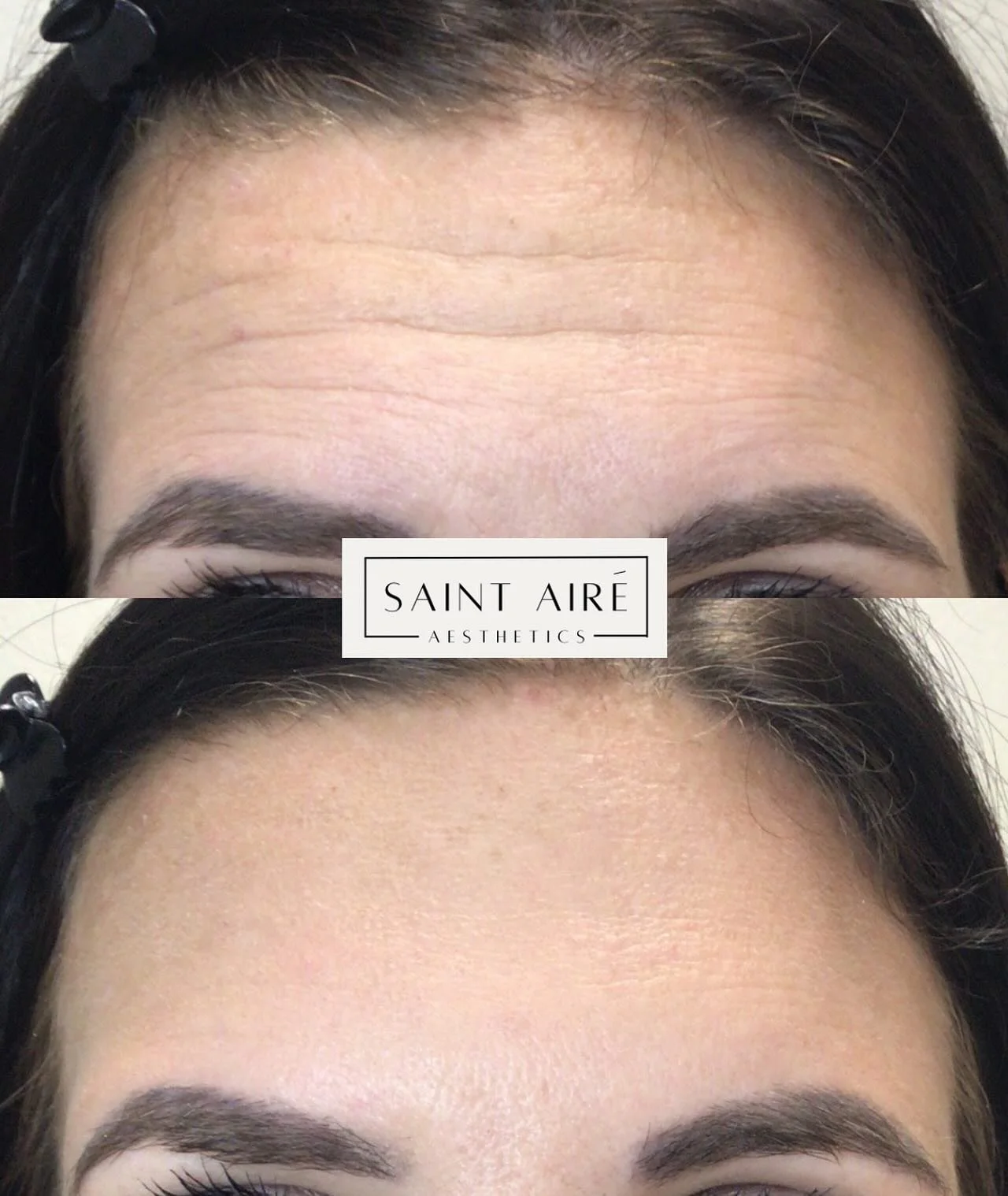 ✨ Static lines ✨ be gone! 🪄

These are the lines that are visible at rest. Reducing the repetitive movement with Botox allows your skin to repair itself ➡️ improving those lines and preventing them from getting deeper.

This photo is only 2 weeks po