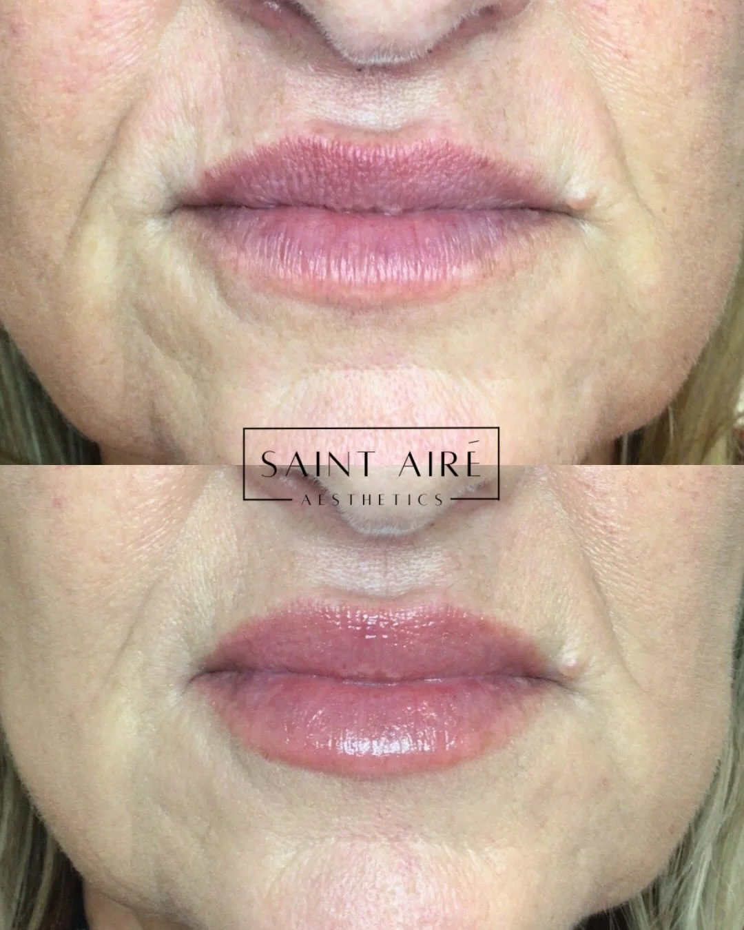 ✨A little refresh goes a long way ✨

Healed results from just 1/3 syringe of lip filler (layered over previous filler). Perfect for subtle maintenance, hydration, and shape without overfilling. 

#tailoredtreatments #lipfiller #maintenance #subtleenh