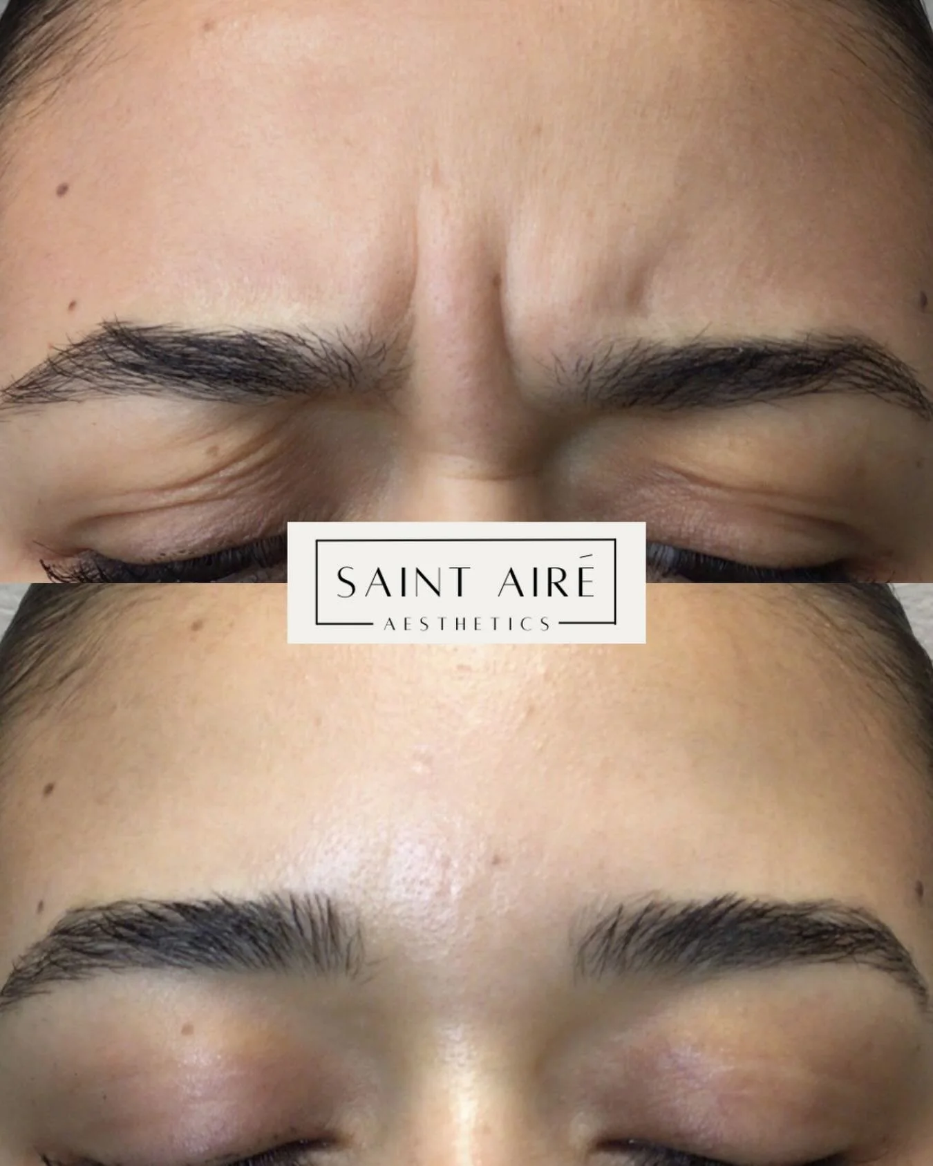 ✨Glabellar Botox ✨to soften frown lines and help prevent deeper creasing. Results typically last 3&ndash;4 months. 

➡️ schedule your appointment today!

#Botox #Dysport #botoxbeforeafter #aestheticnp #downtownjacksonville