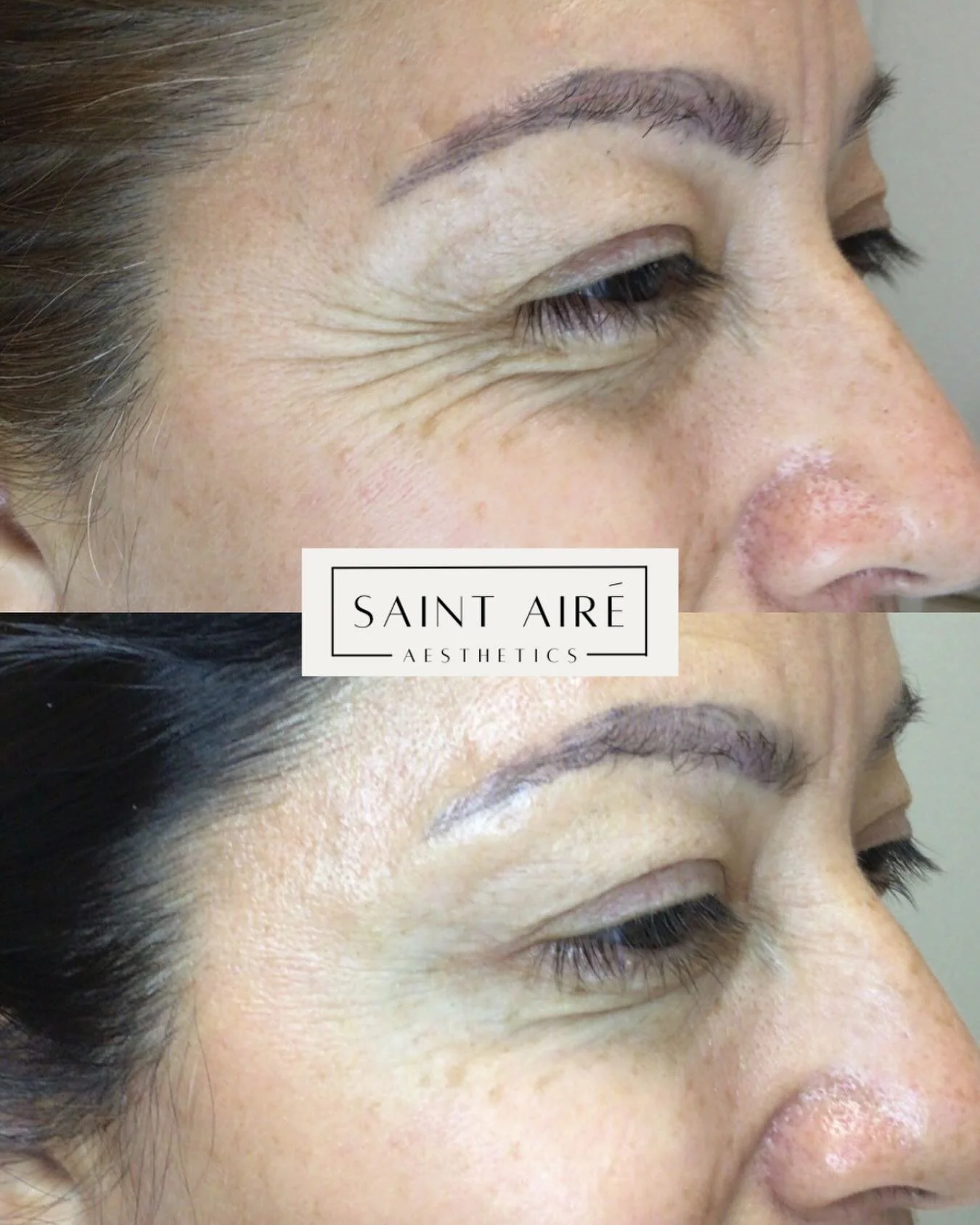 ✨ CROWS FEET ✨ 

Because smiling should never be something you regret. Botox works by relaxing the muscles that cause repetitive smile lines ➡️ resulting in smoother skin while preserving expression for a refreshed, natural look.

#Botox #crowsfeet #