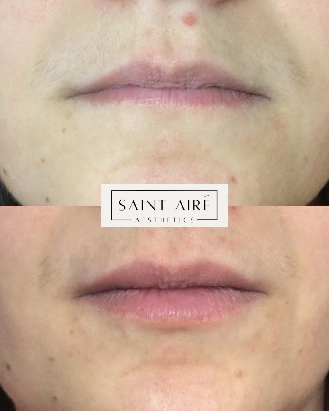 ✨ Subtle volume. Balanced shape. Natural beauty. 💉

1 month post treatment of just 1/2 syringe of lip filler - strategically placed.

Whether you want a little hydration, more definition, or a soft plump, treatments are fully customized to your natu