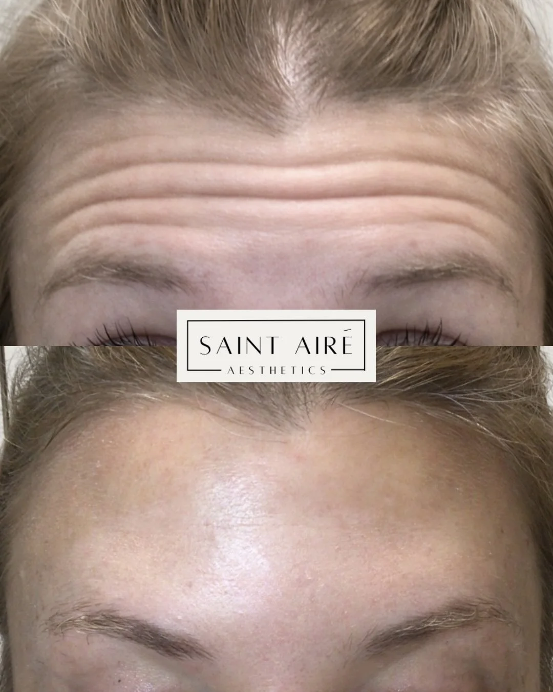 Where technique meets artistry ✨

Strategic dosing and placement of Botox allows for line softening and a controlled, subtle brow lift. Never heavy, never overdone. 

1st photo: Before/after of patient raising brows
2nd photo: Before/after of patient