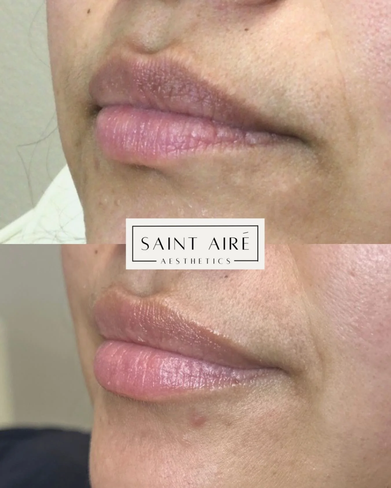 ✨ Soft, natural volume. Never overdone 🤍
1 month post lip filler. Trust the healing process.

Appointments available 💉