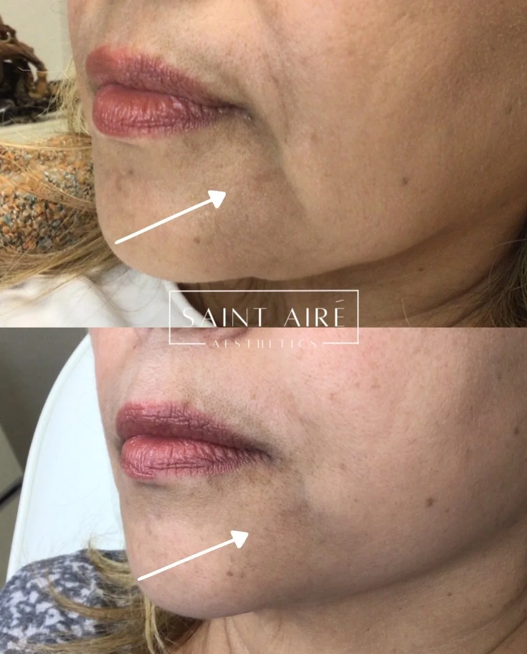 ✨ Fine line filler ✨ to soften nasolabial folds and marionette lines and reduce shadowing for a smoother transition.

Link in bio to schedule your next appointment! 🫶🏼