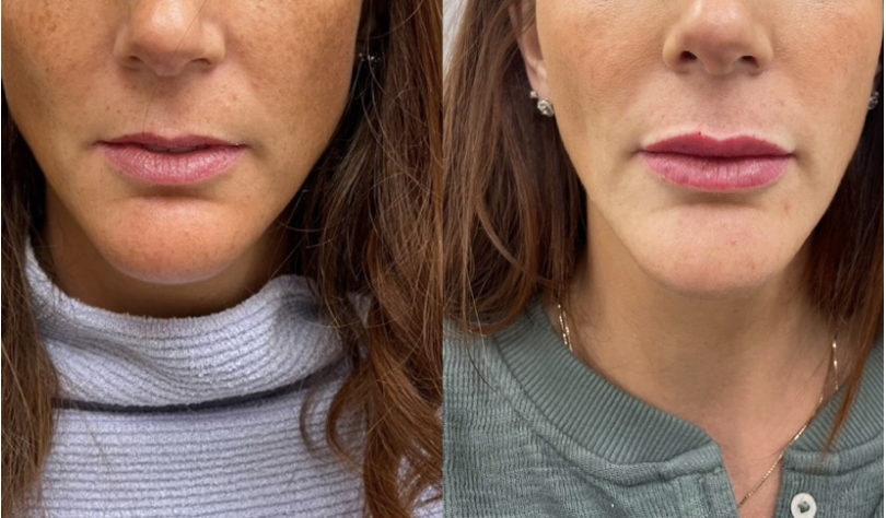 before and after lips.png