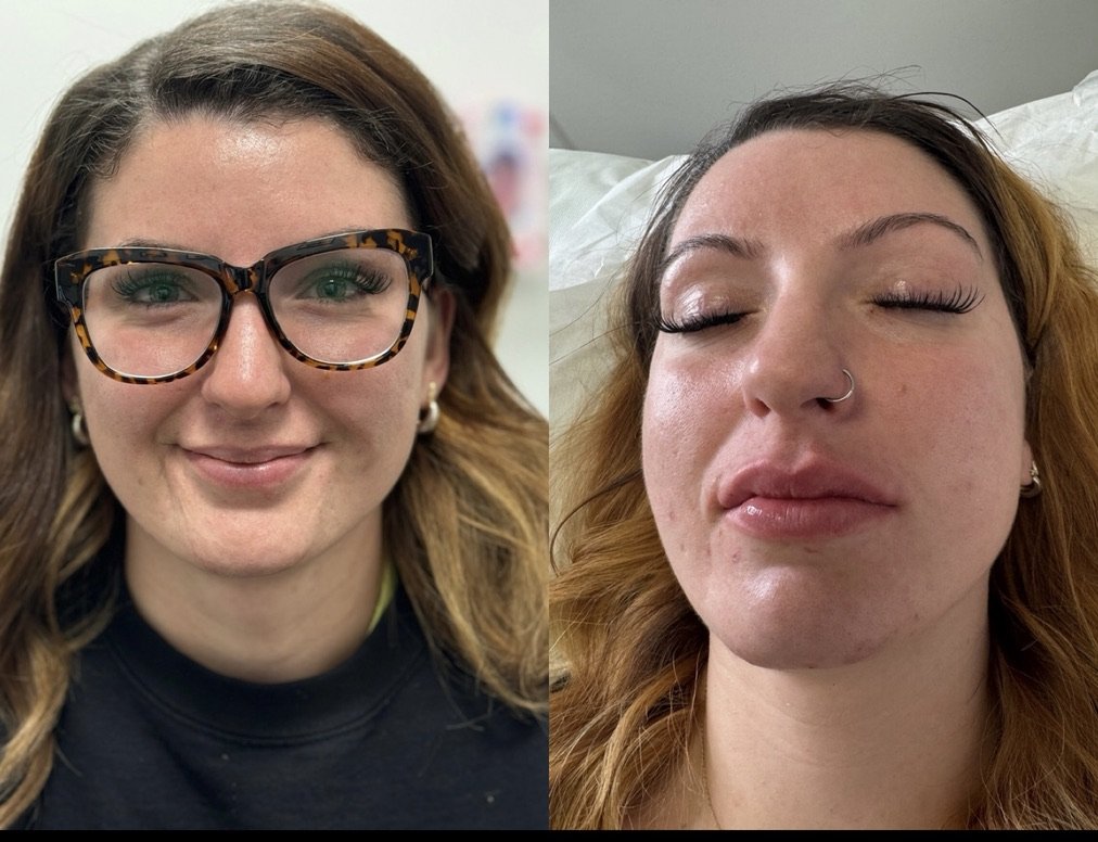 before and after_lips.jpeg