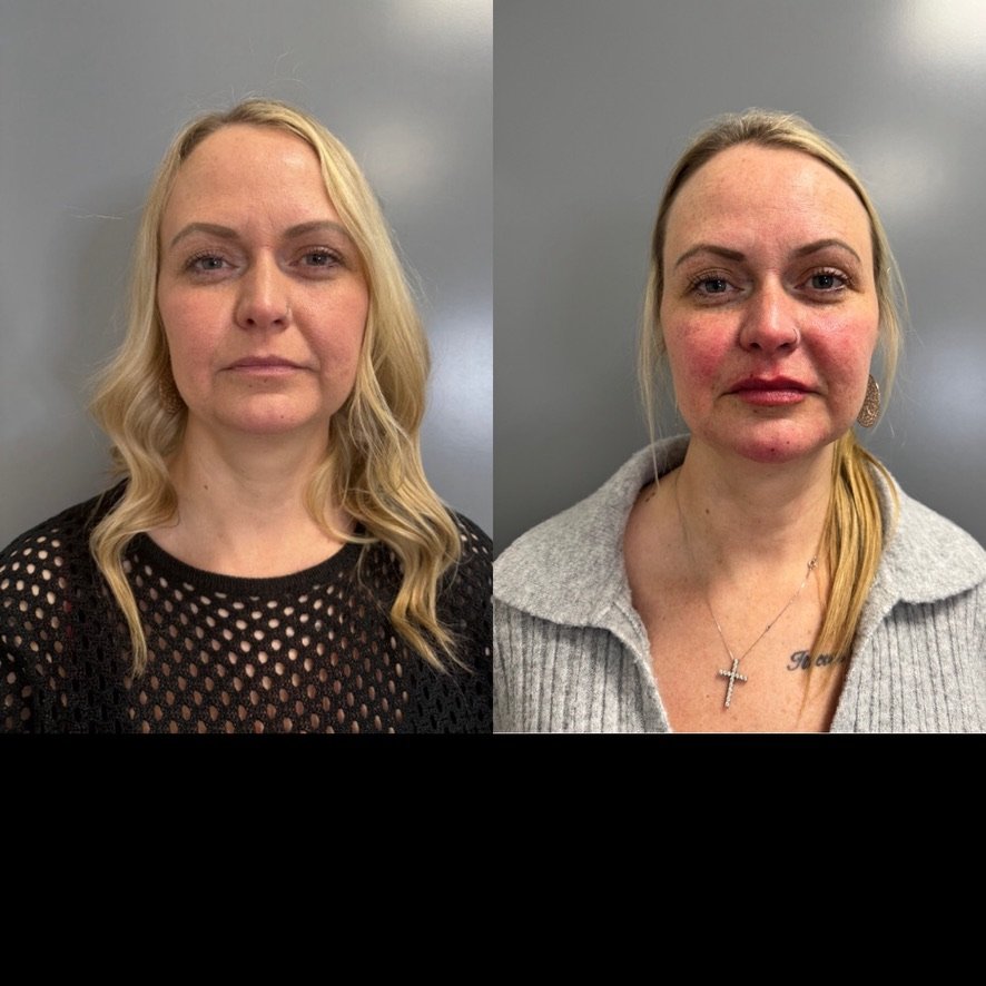 before and after_lower face filler.jpeg