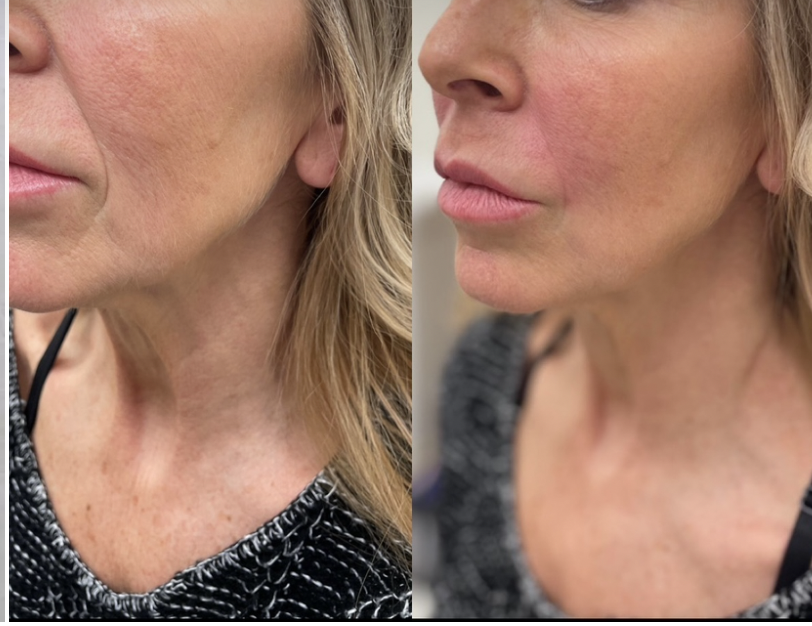 before and after nasolabial fold.png