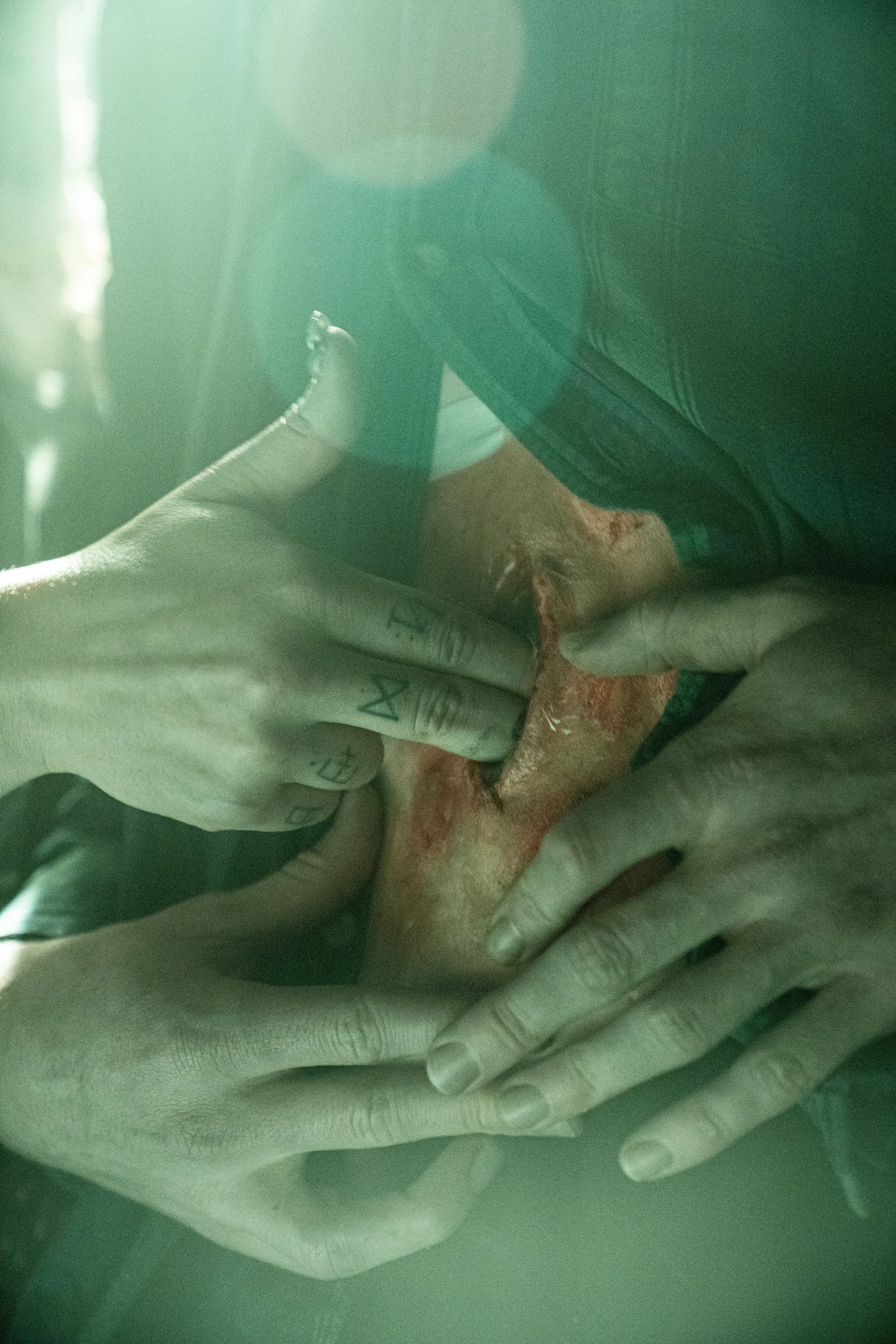 A person performing open-heart surgery on a patient, with multiple hands assisting and a surgical instrument in use.