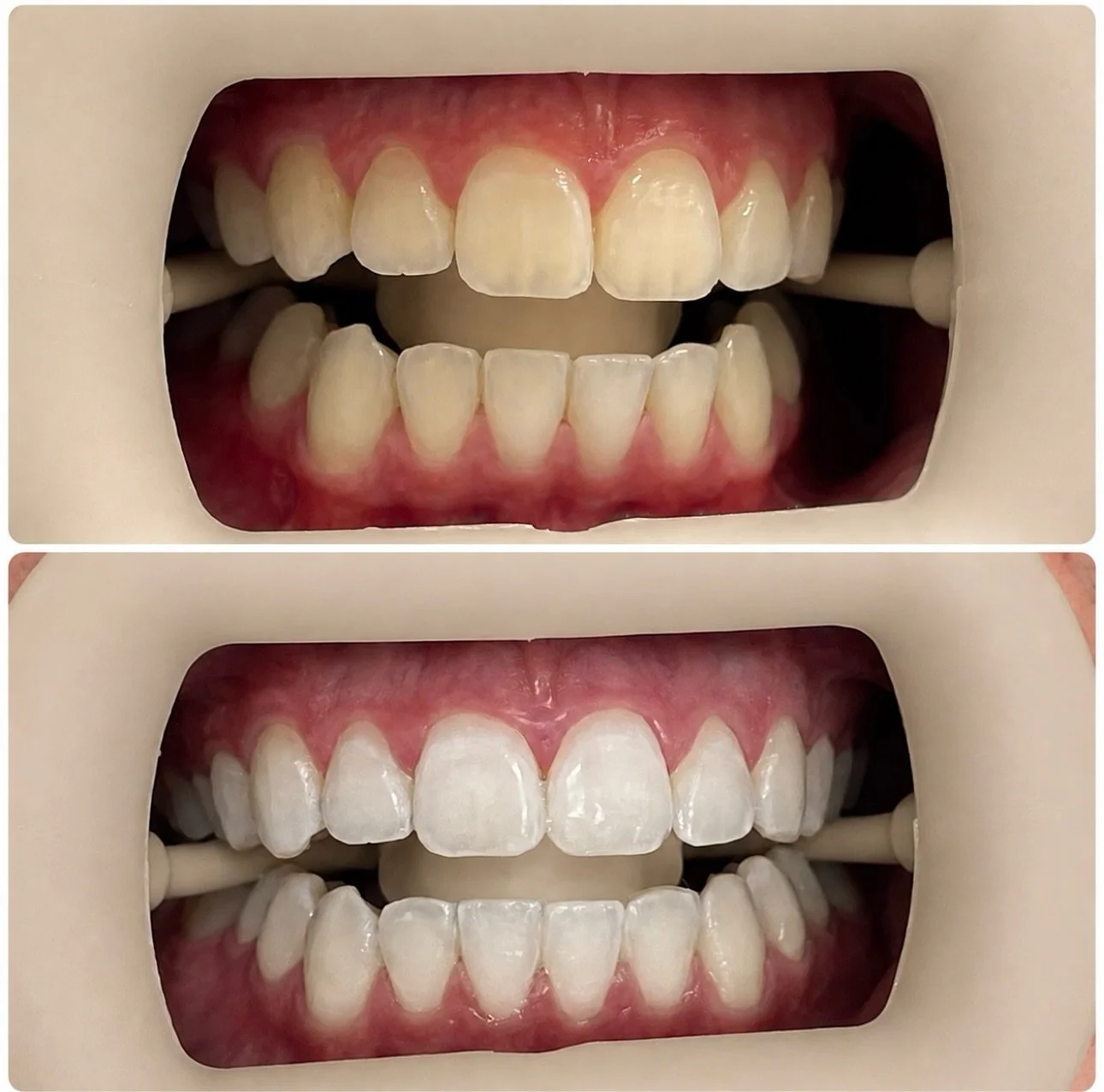 &bull; ONE SESSION 

A natural brightening designed to enhance your smile without looking overdone.

Results may vary depending on natural tooth shade, lifestyle factors, and individual response to treatment.