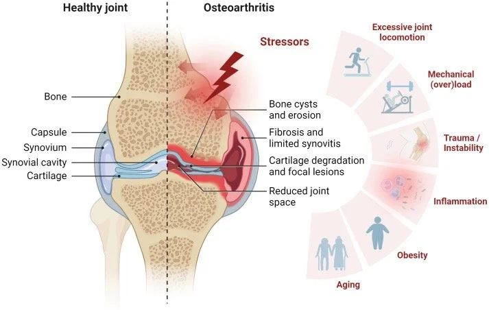 I Have Arthritis. Now What? Why Your X-Ray Doesn’t Tell the Whole Story