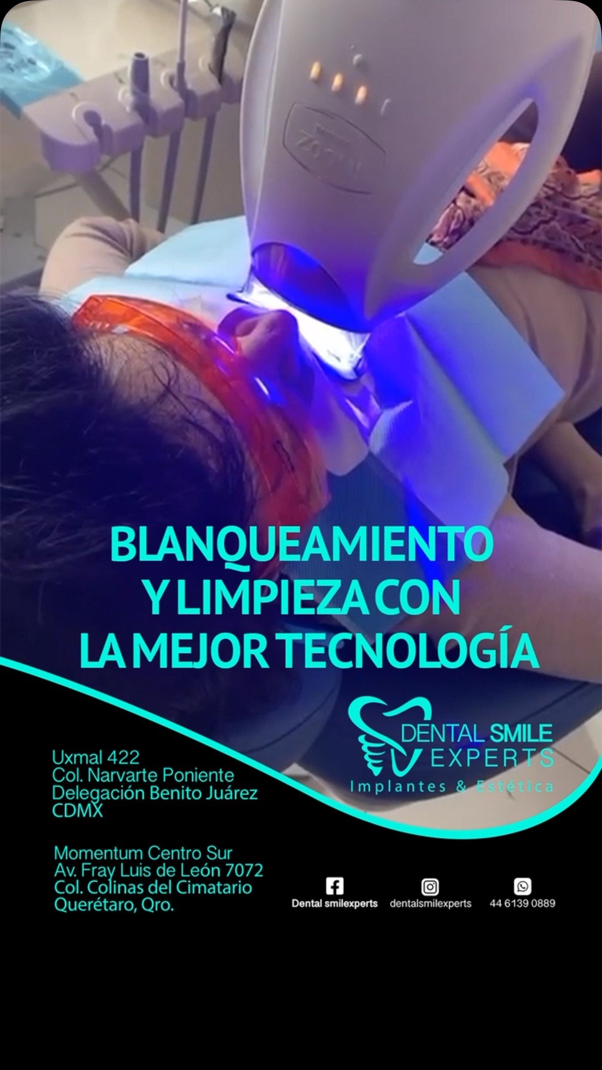 En DENTAL SMILE EXPERTS te garantizamos un aclaramiento dental de buena calidad, con la mejor tecnología en el mercado.
En tan solo 1 hora verás el cambio + incluye limpieza
.
Blanqueamiento #limpieza #zoom
