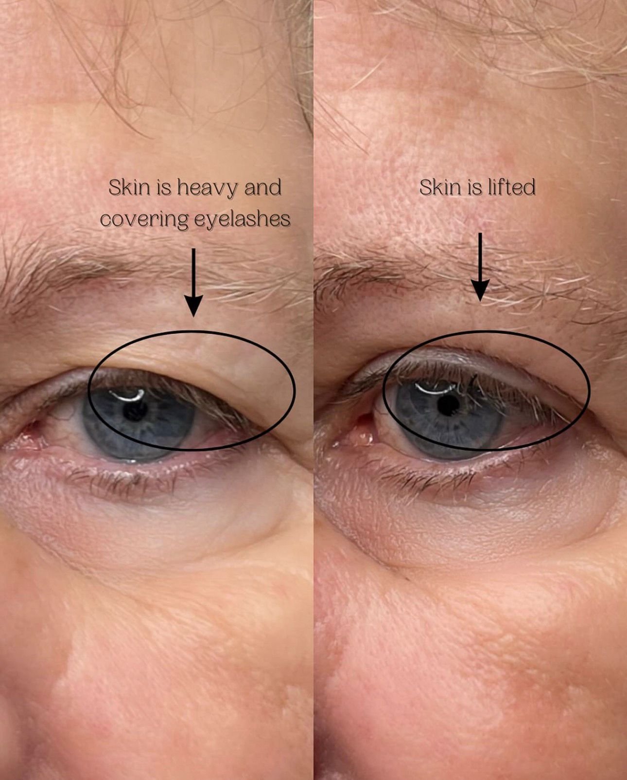 Plasma Pen-Non-Surgical Skin Tightening &amp; Removal