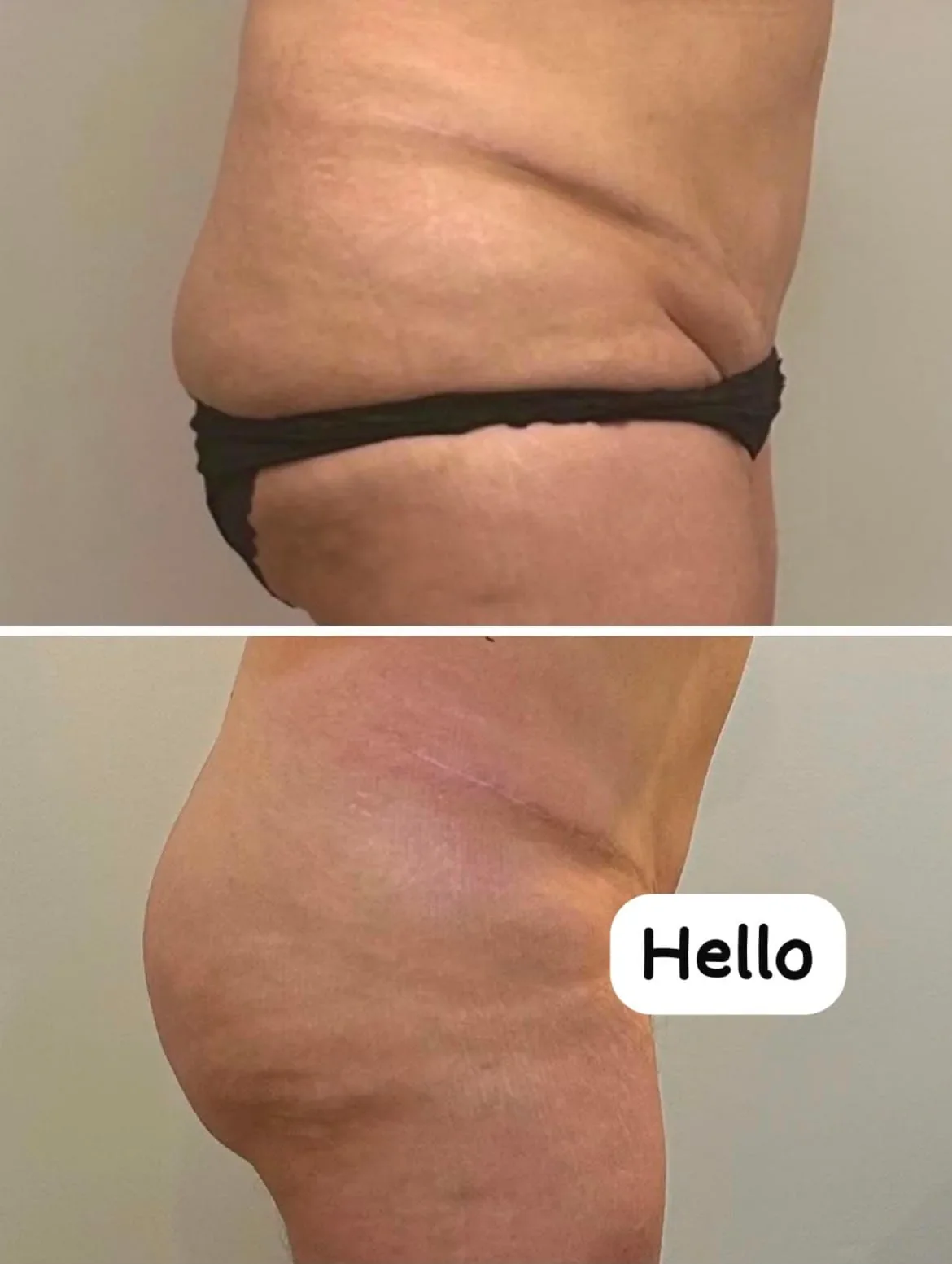 Before and after waist and love handles results from lymphatic drainage massage at The Contour Method, Melbourne
