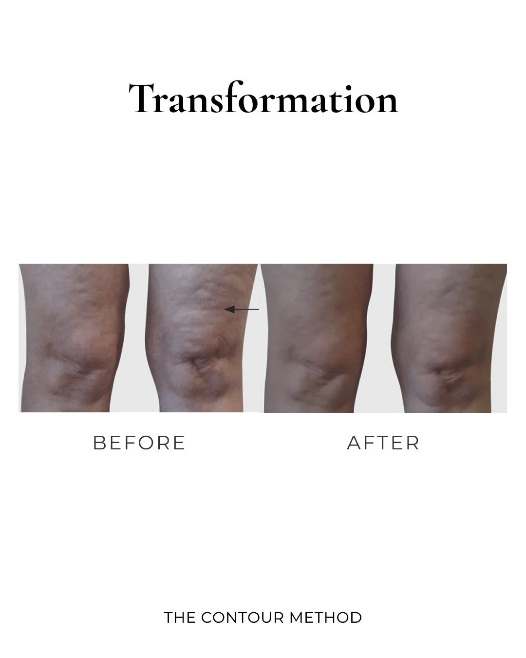 At THE CONTOUR METHOD, 
your journey begins with a personalised assessment during your first session. 

We take the time to understand your concerns, discuss your goals, and create a tailored treatment plan designed to deliver visible, lasting result