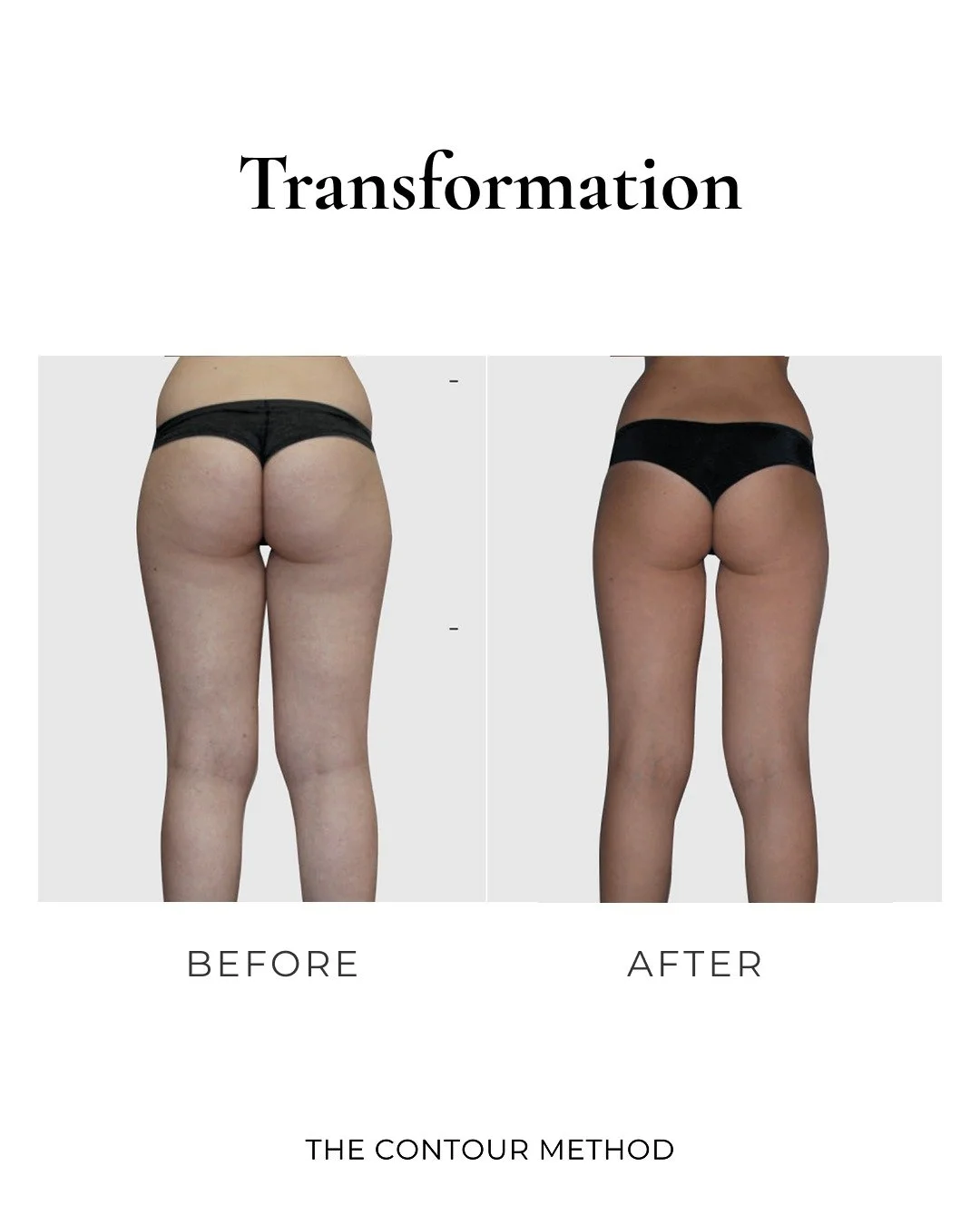 At THE CONTOUR METHOD, your journey begins with a personalised assessment during your first session. We take the time to understand your concerns, discuss your goals, and create a tailored treatment plan designed to deliver visible, lasting results.

