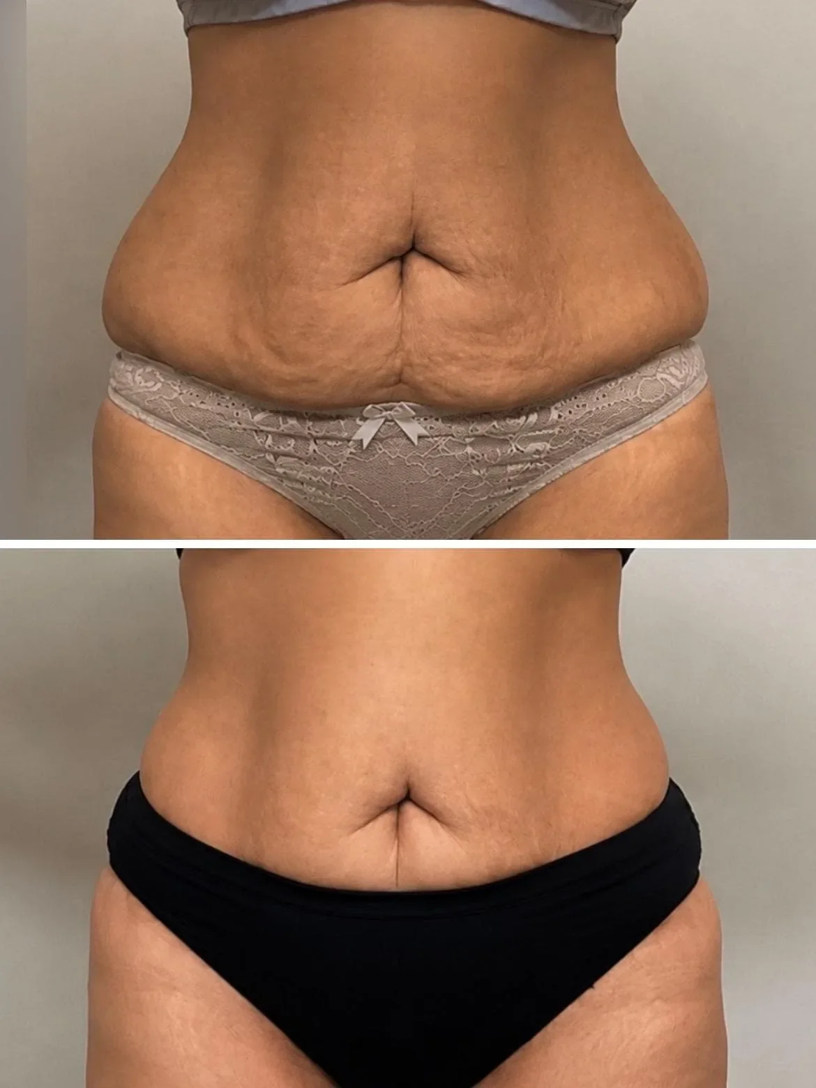 That's the stomach photo with the lace underwear (loose skin before/after) — file cellulite-reduction-treatment-stomach-before-after-melbourne.webp. Alt text:  "Before and after stomach skin tightening results from cellulite reduction treatment at Th