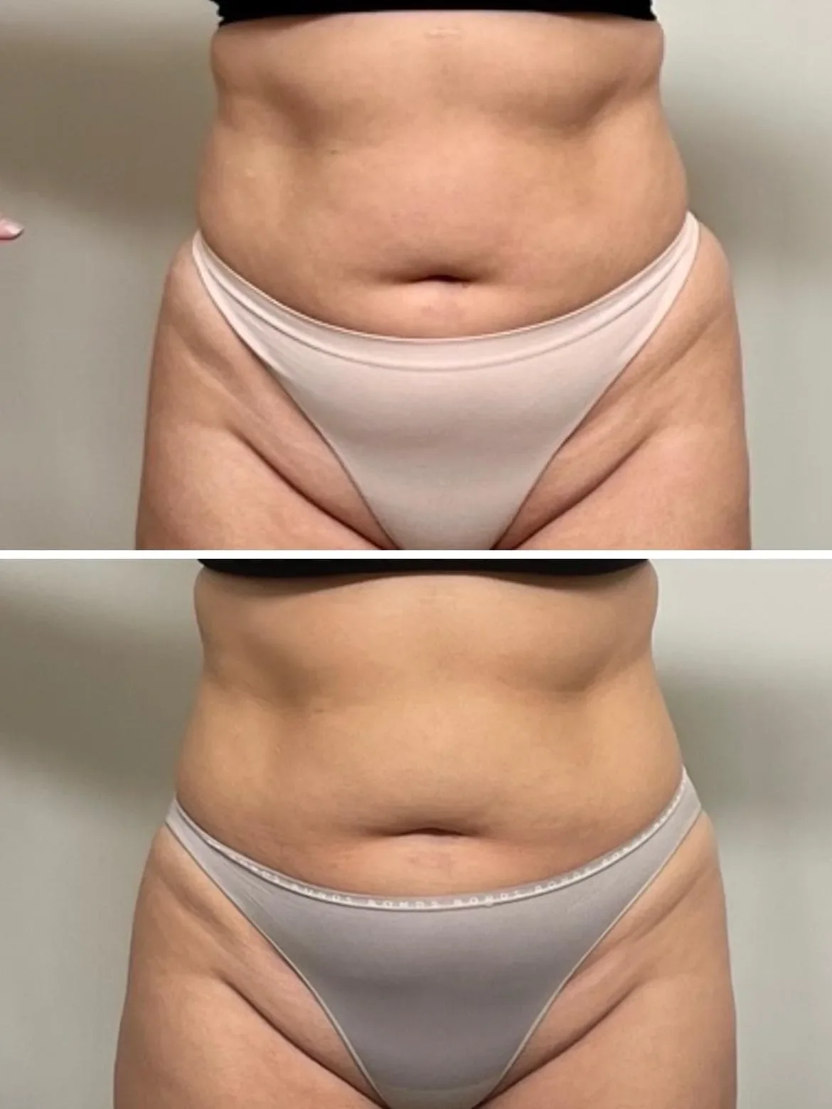 Before and after abdomen results from lymphatic drainage massage at The Contour Method, Melbourne