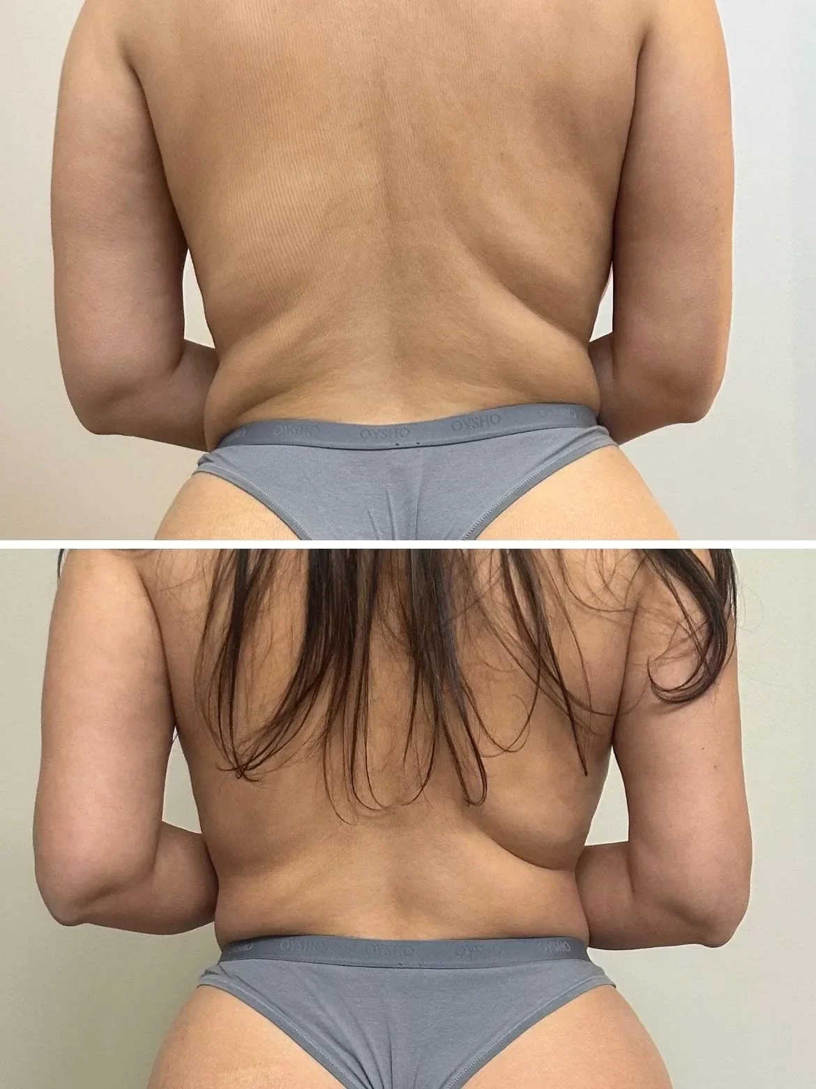 Before and after back results from lymphatic drainage massage at The Contour Method, Melbourne