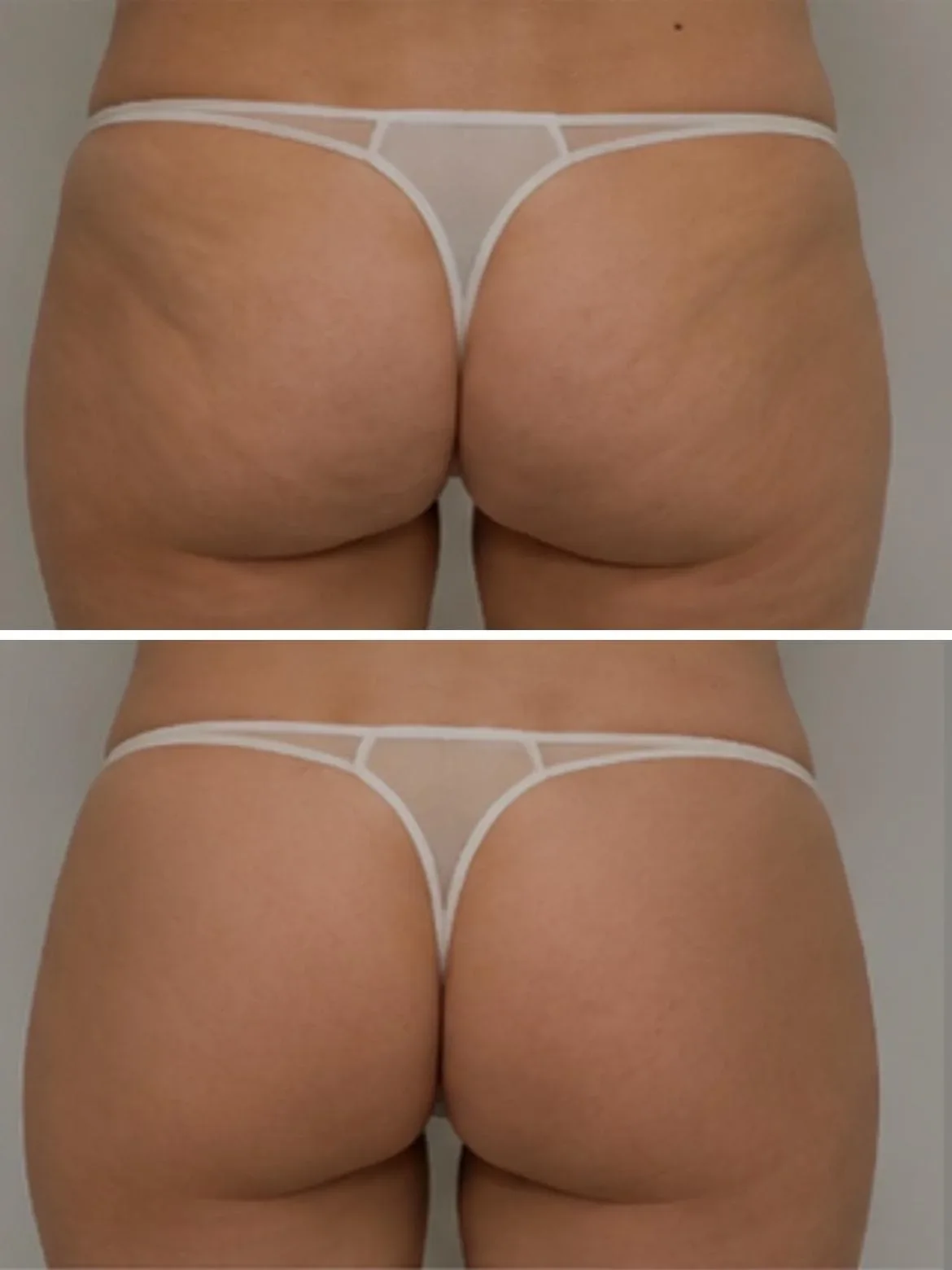 Before and after buttocks results from cellulite treatment at The Contour Method, Melbourne