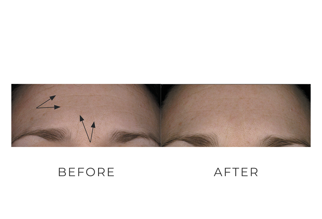 Close-up of a woman's forehead showing a before-and-after comparison of wrinkle reduction, with arrows pointing to previous lines on the left and smooth skin on the right.