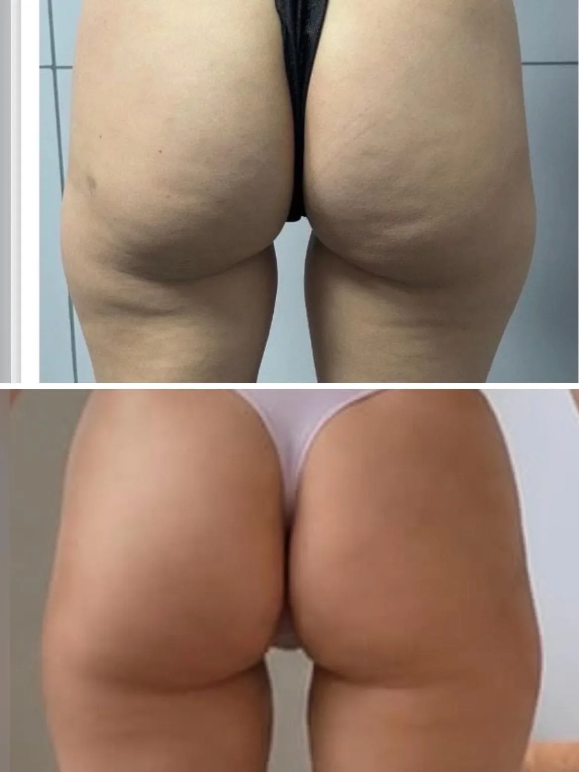 Before and after thigh and buttock results from cellulite massage at The Contour Method, Melbourne