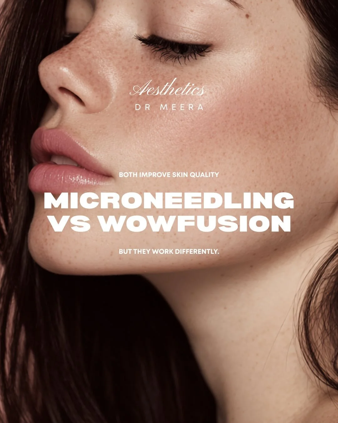 Both improve skin quality&hellip;but they work differently.

💉Microneedling 

&rarr; Collagen stimulation

&rarr; Texture &amp; scarring improvement

&rarr; Gradual long-term change

⭐️WowFusion

&rarr; Instant glow + hydration

&rarr; Mesotherapy i
