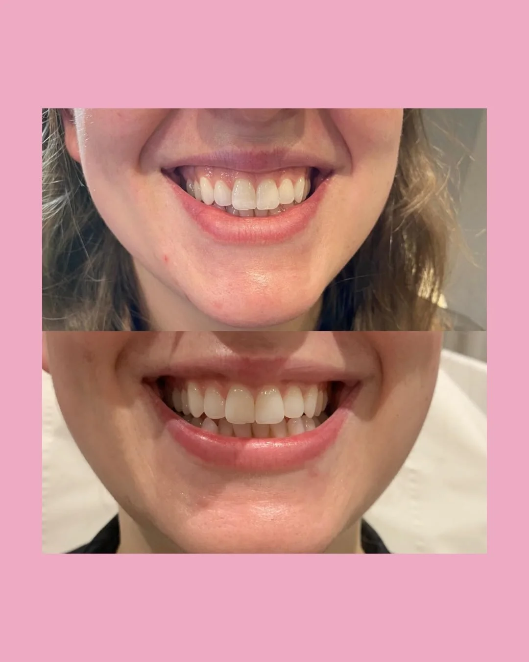 Real results = real confidence!! Offering a range of medical aesthetics treatments in Brighton &amp; Glasgow

📲Book your consultation now and see the transformation yourself!