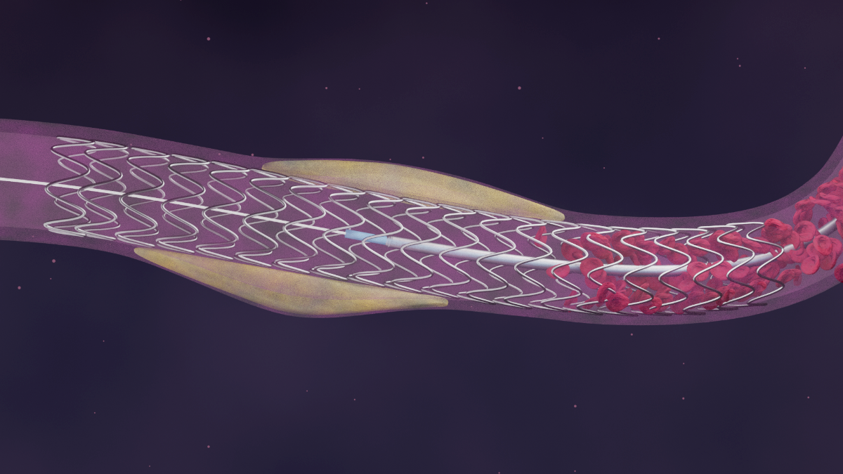 Claroswift Medical Scene showing stent placement