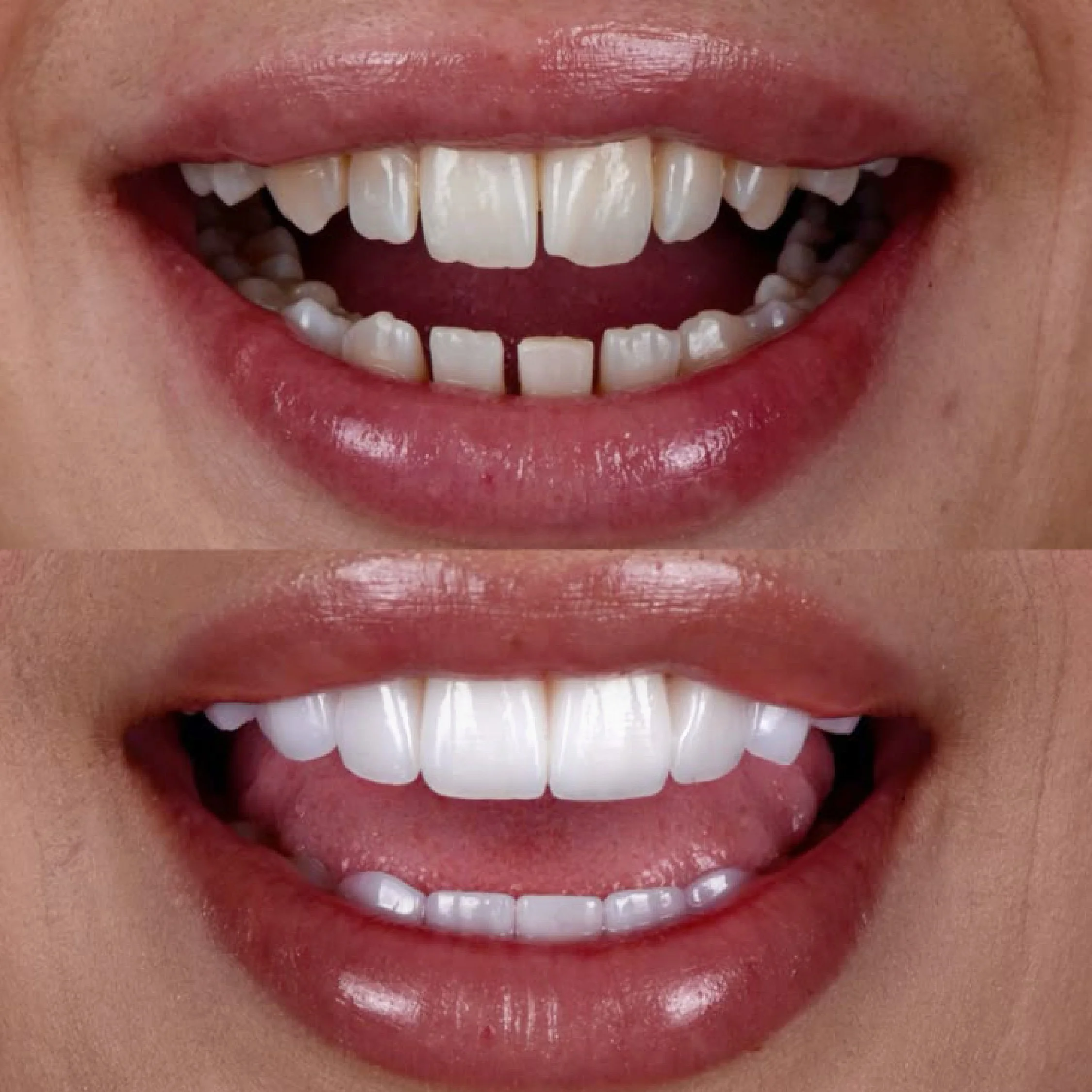 Close-up of a model of human upper teeth with some gums visible, showing the front teeth in a row from left to right.