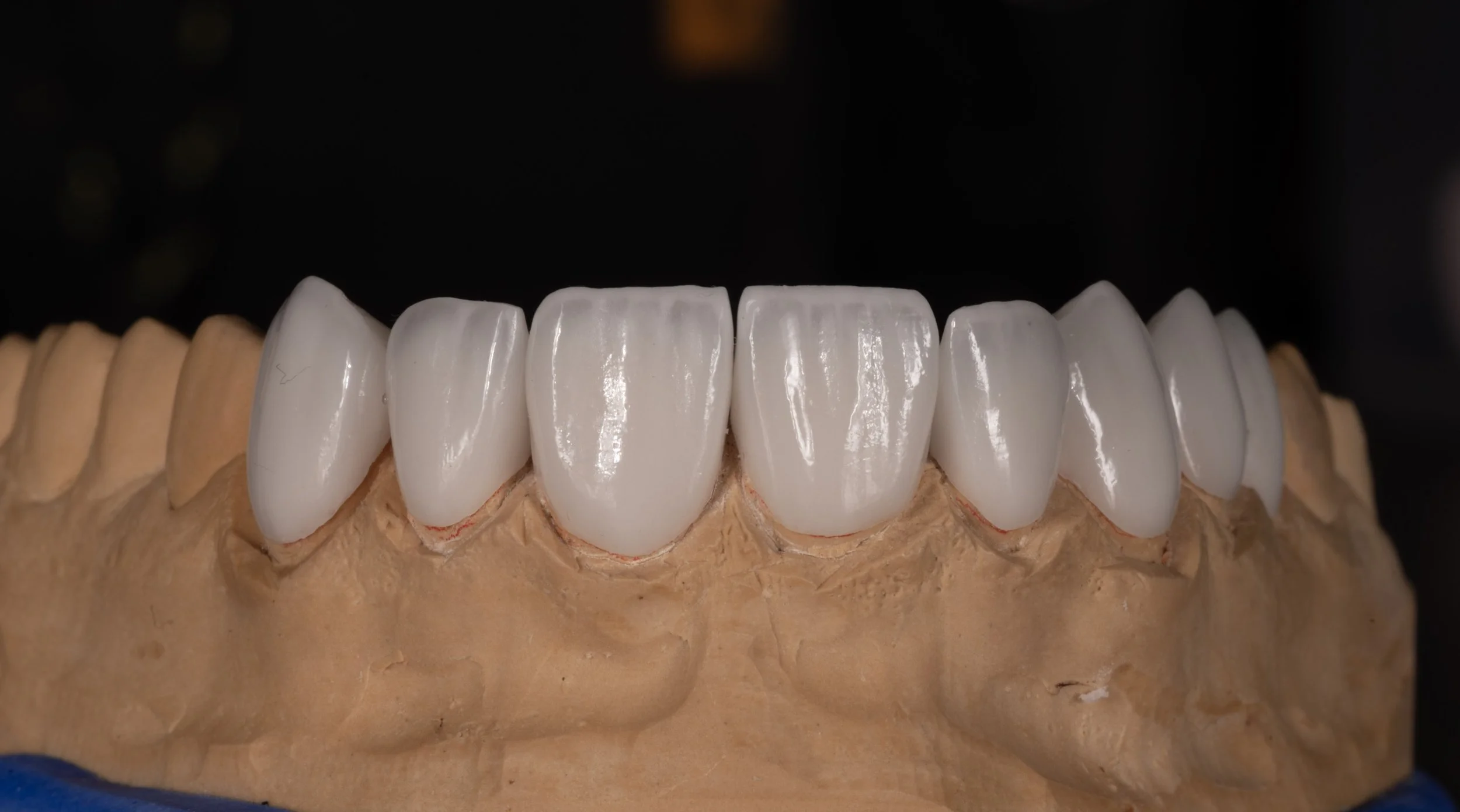 A dental model displaying a set of white dental crowns or veneers fitted onto a mold of upper teeth.
