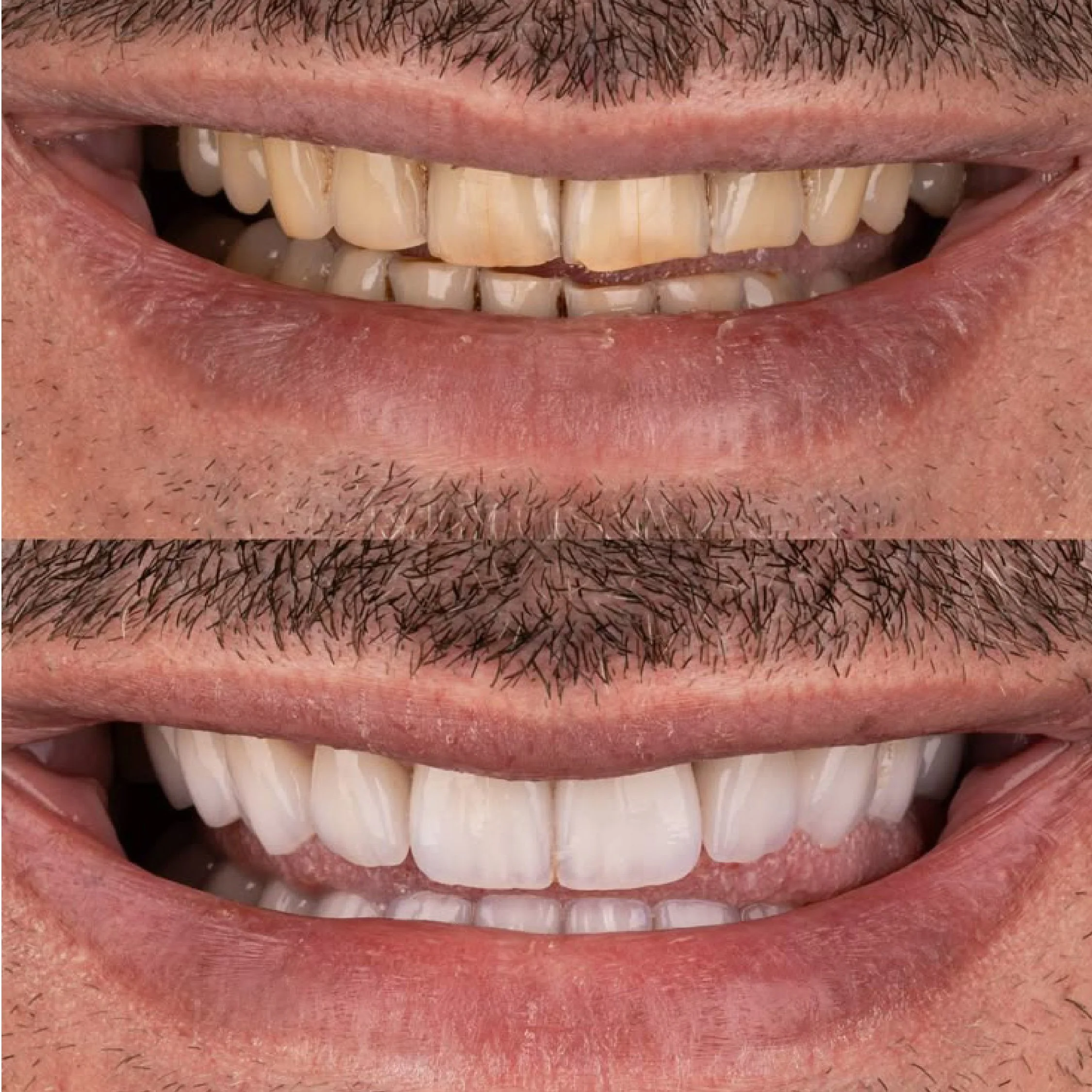 Close-up of a smiling person's mouth showing teeth and lips, with visible facial hair on the upper lip and chin.