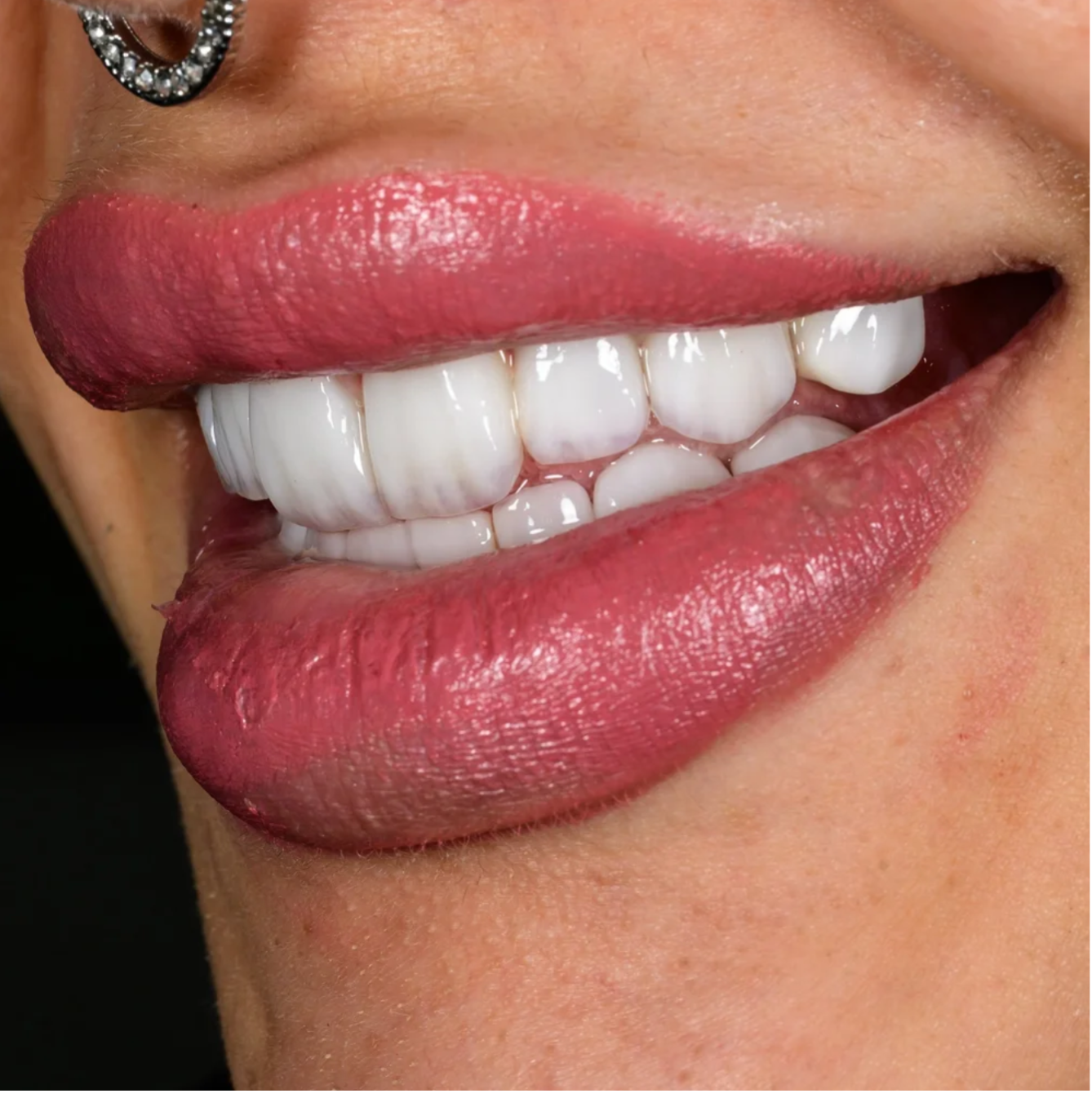 Close-up of a smiling person with pink lipstick, showing white teeth and a gold tooth cap on the upper front tooth.