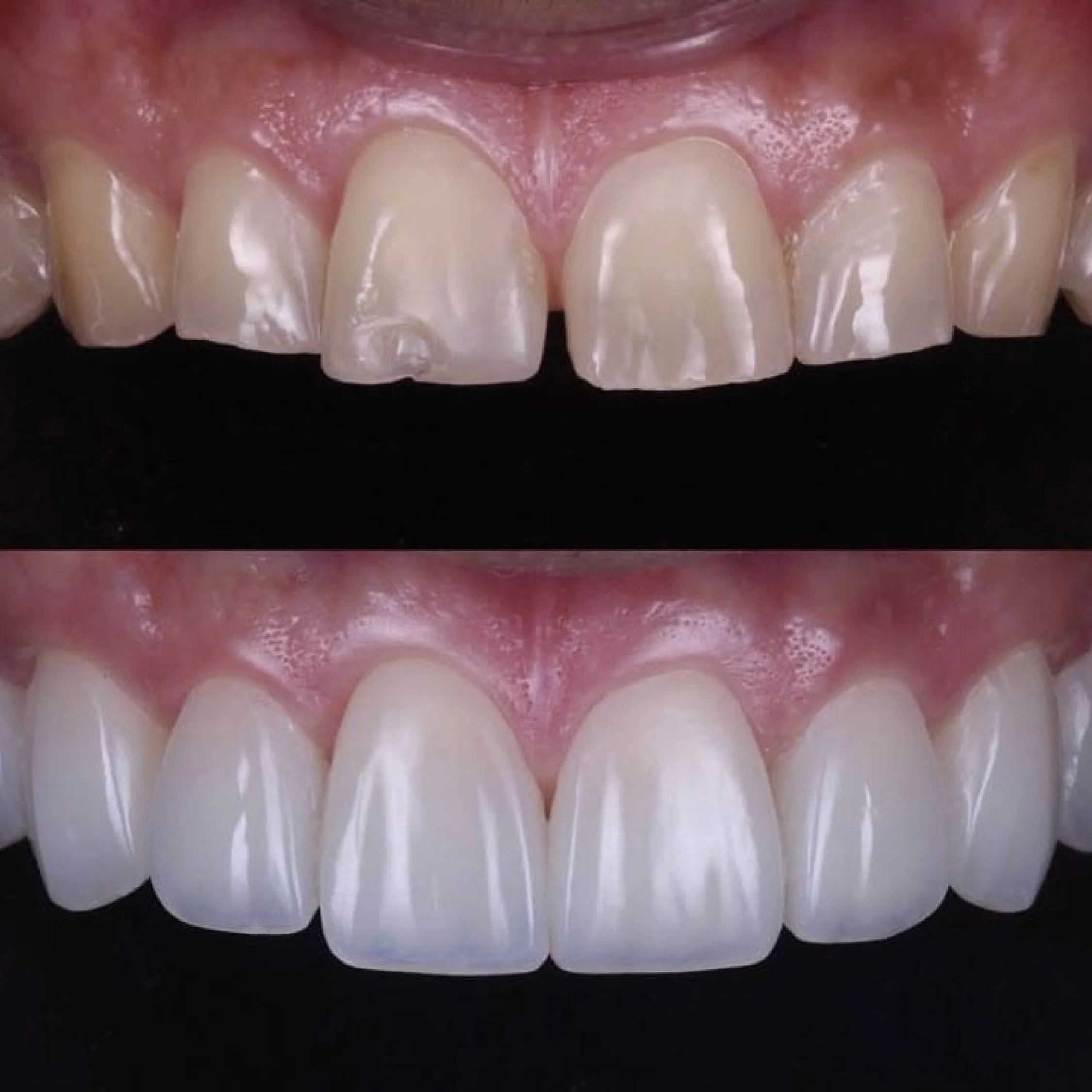 Close-up of upper front teeth and gums, showing healthy teeth and pink gums.