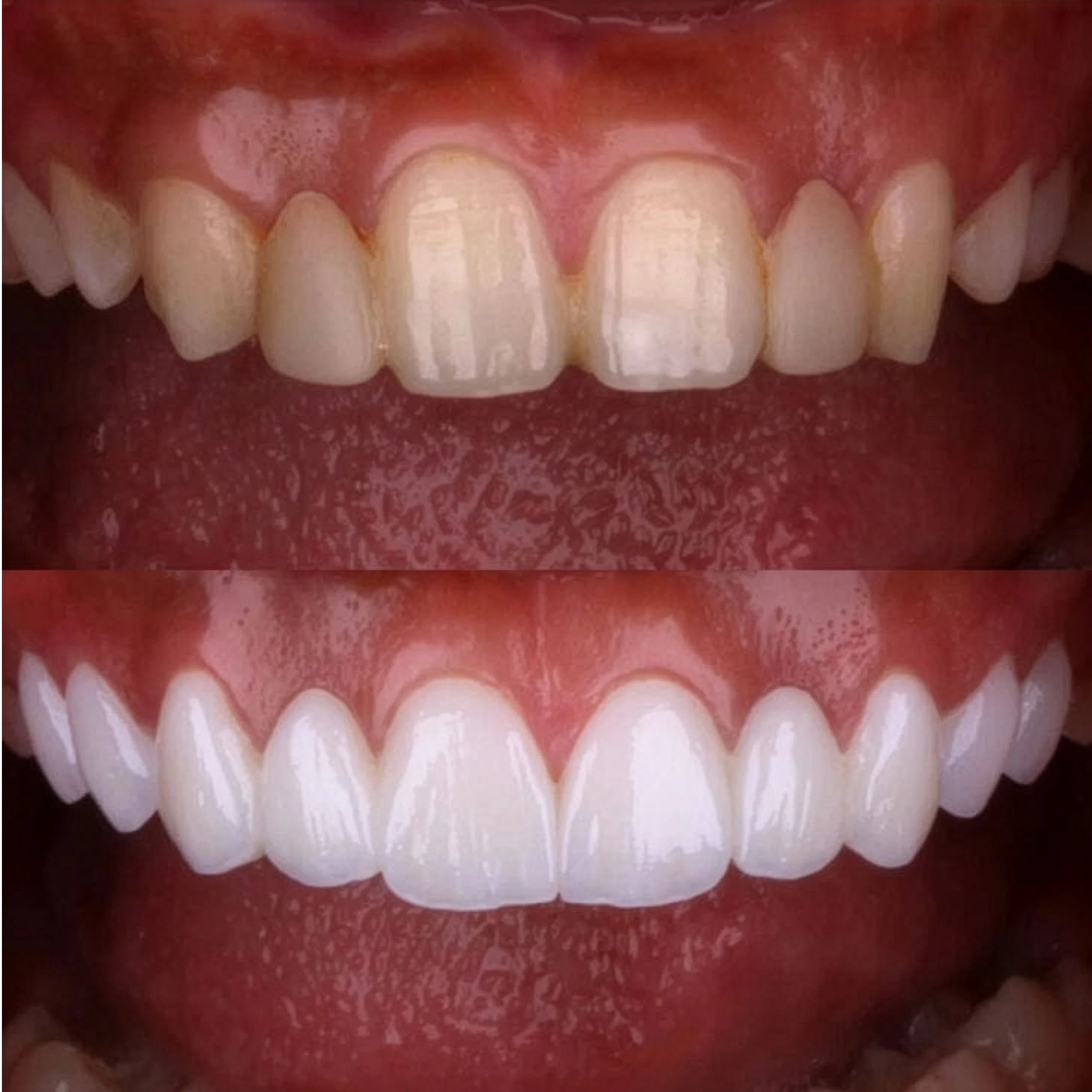 Close-up of lips with red lipstick and teeth visible between them.