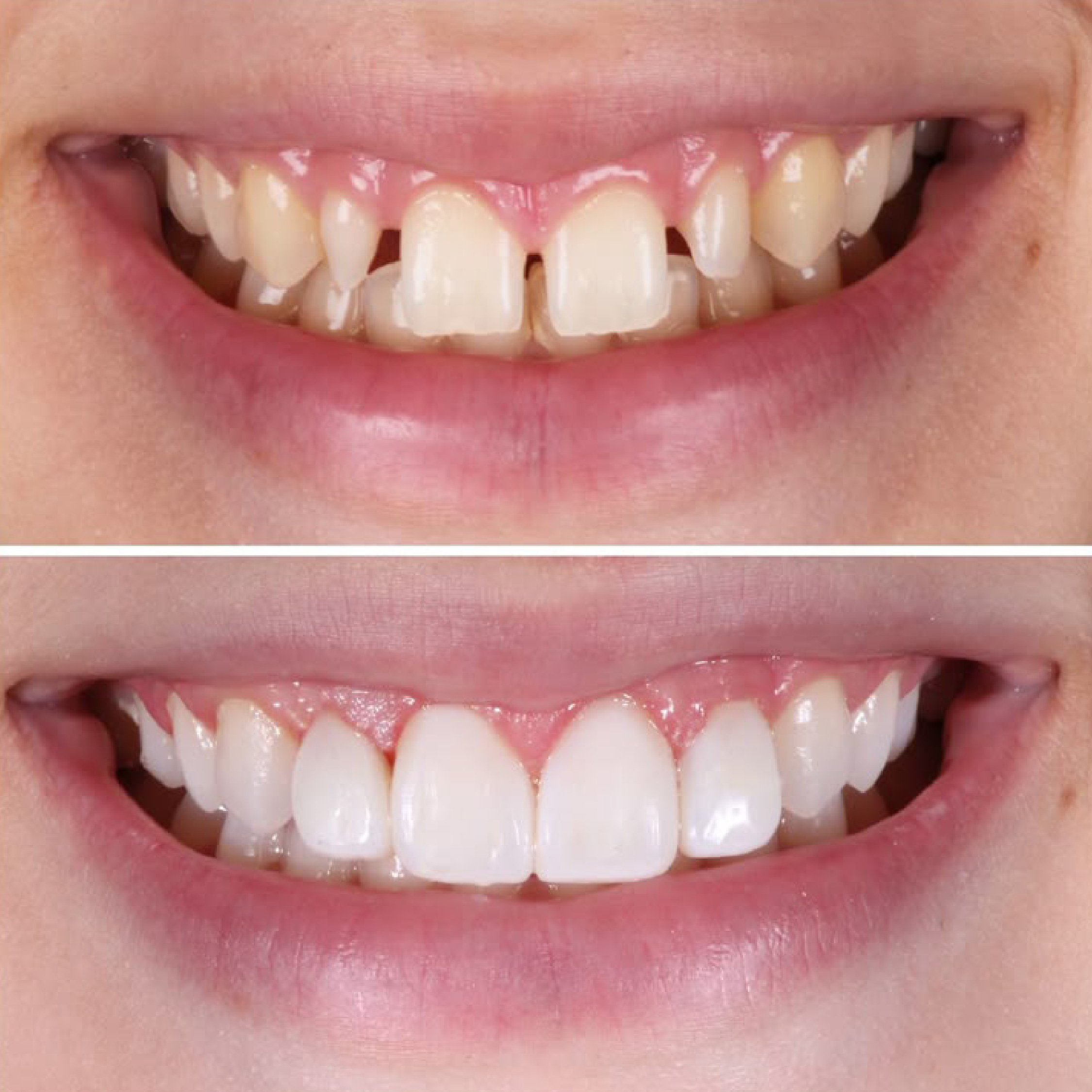 Close-up of a person's mouth showing a wide smile with white teeth, a mustache, and part of the nose visible.